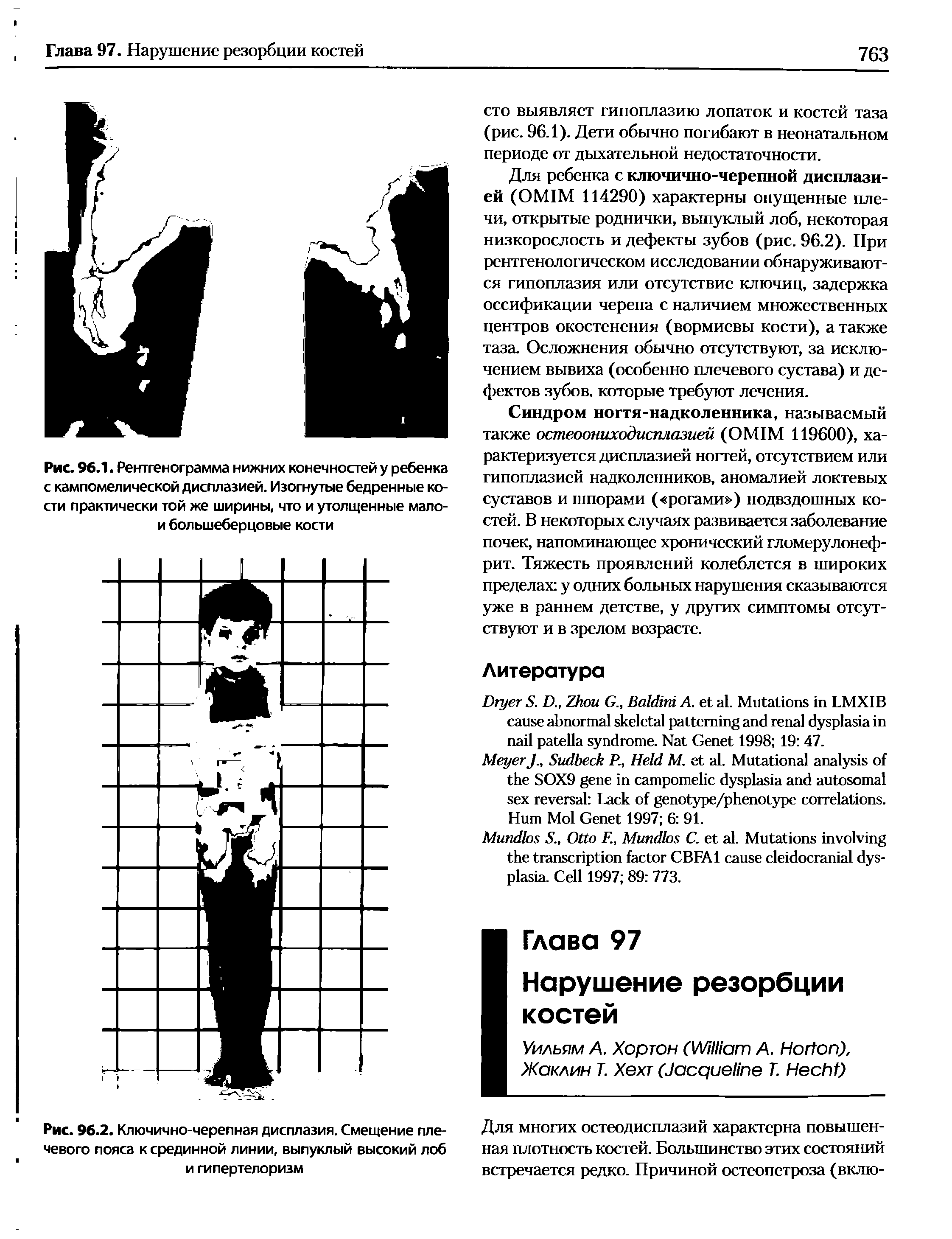 Рис. 96.2. Ключично-черепная дисплазия. Смещение плечевого пояса к срединной линии, выпуклый высокий лоб и гипертелоризм...