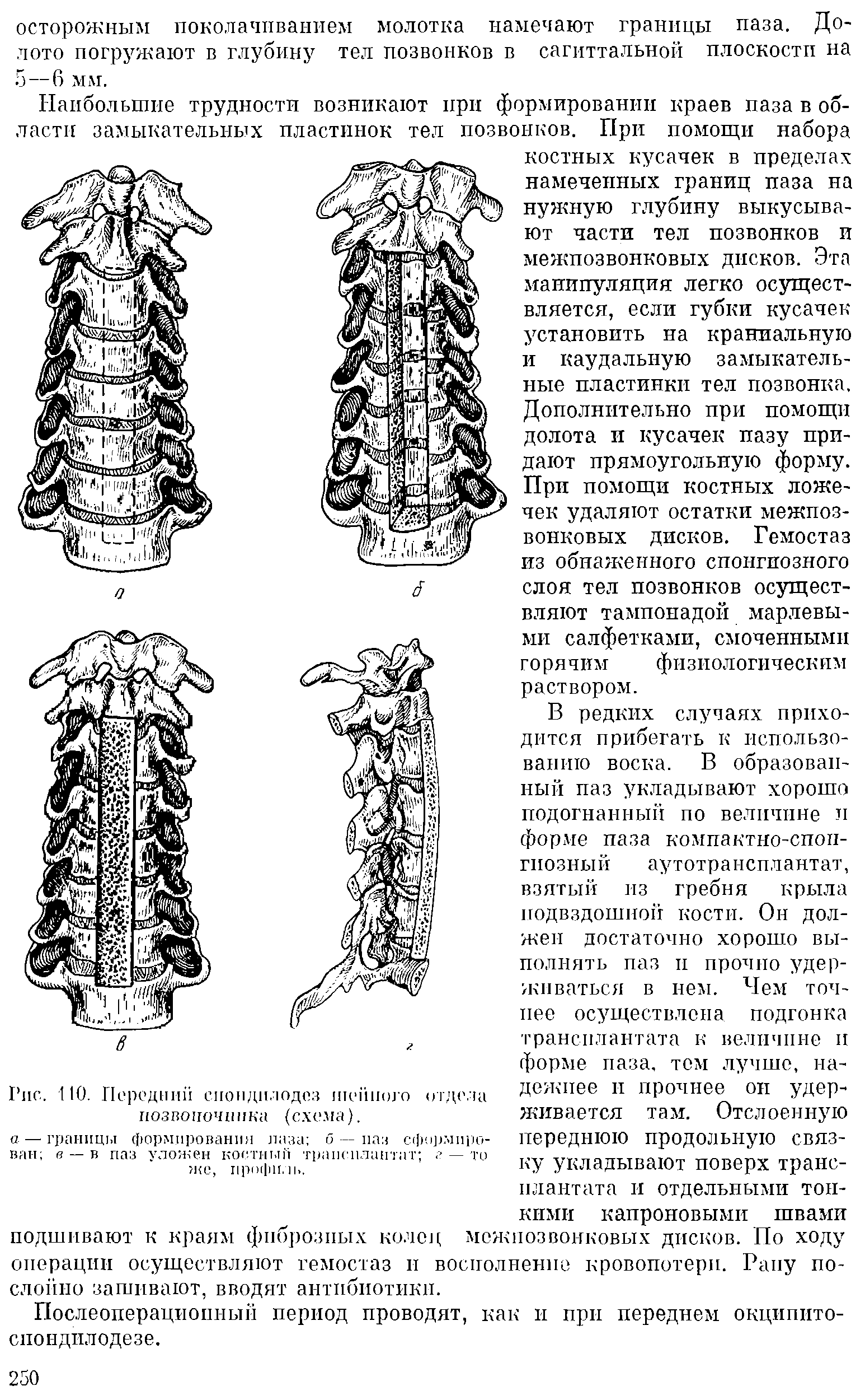 Рис. 110. Передний спондилодез шейного отдела позвоночники (схема).