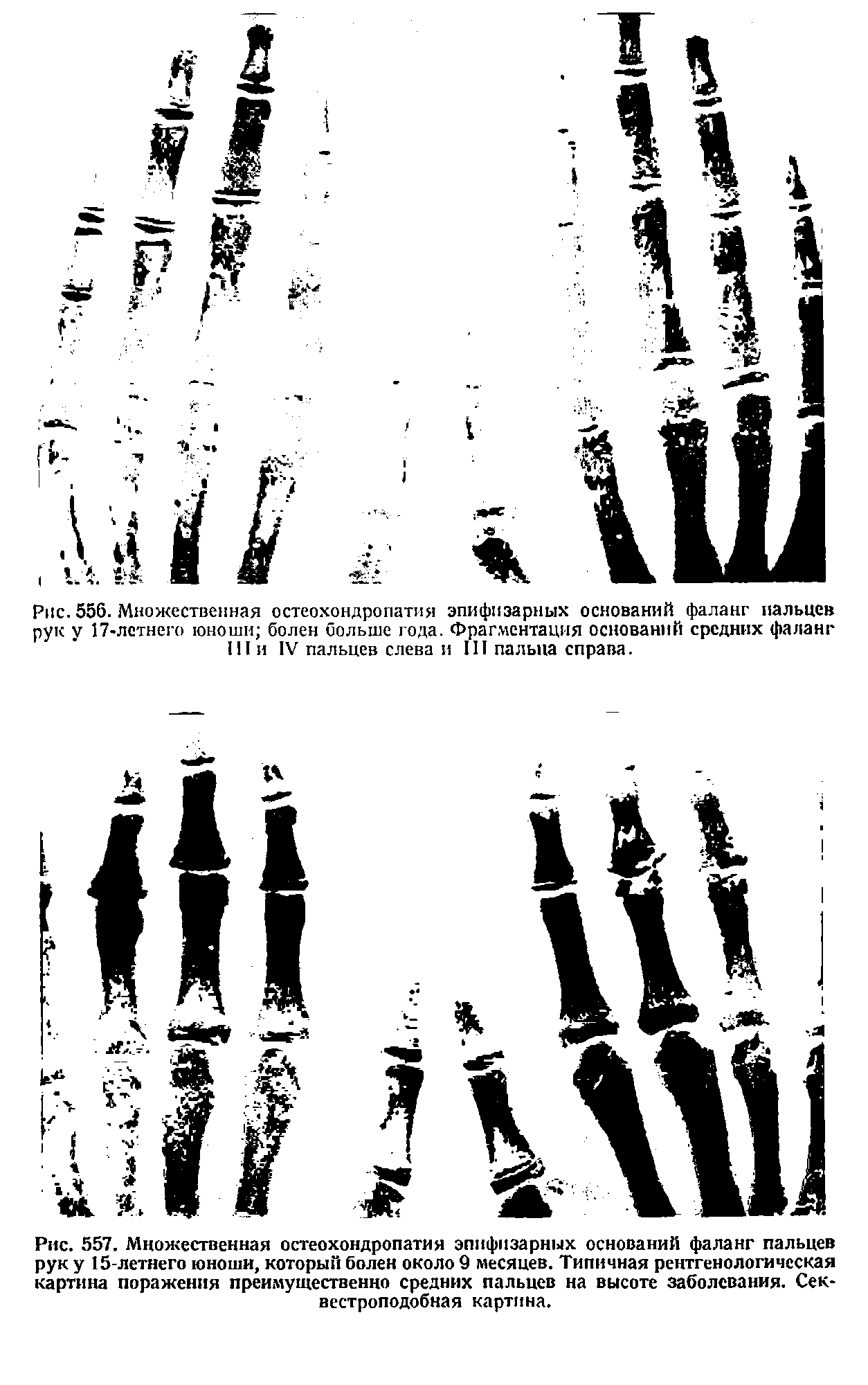 Рис. 557. Множественная остеохондропатия эпифизарных оснований фаланг пальцев рук у 15-летнего юноши, который болен около 9 месяцев. Типичная рентгенологическая картина поражения преимущественно средних пальцев на высоте заболевания. Сек вестроподобная картина.