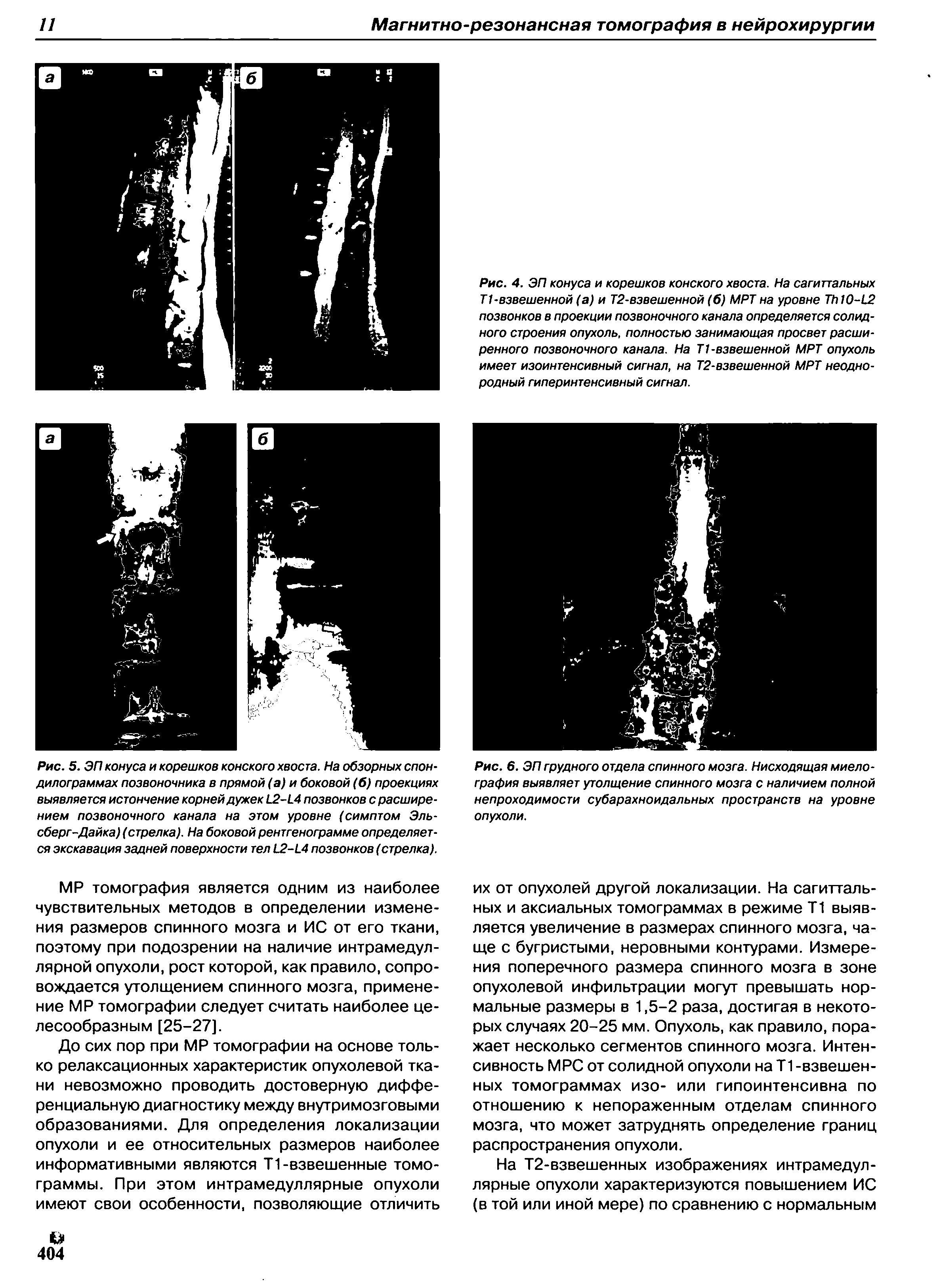 Рис. 6. ЭП грудного отдела спинного мозга. Нисходящая миелография выявляет утолщение спинного мозга с наличием полной непроходимости субарахноидальных пространств на уровне опухоли.