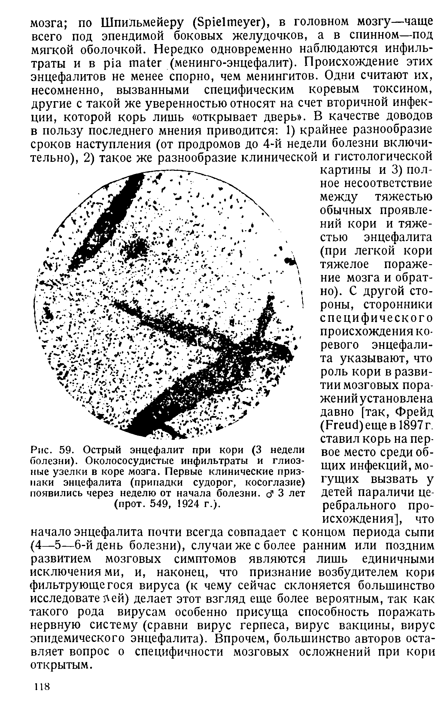 Рис. 59. Острый энцефалит при кори (3 недели болезни). Околососудистые инфильтраты и глиоз-ные узелки в коре мозга. Первые клинические признаки энцефалита (припадки судорог, косоглазие) появились через неделю от начала болезни. с 3 лет (прот. 549, 1924 г.).