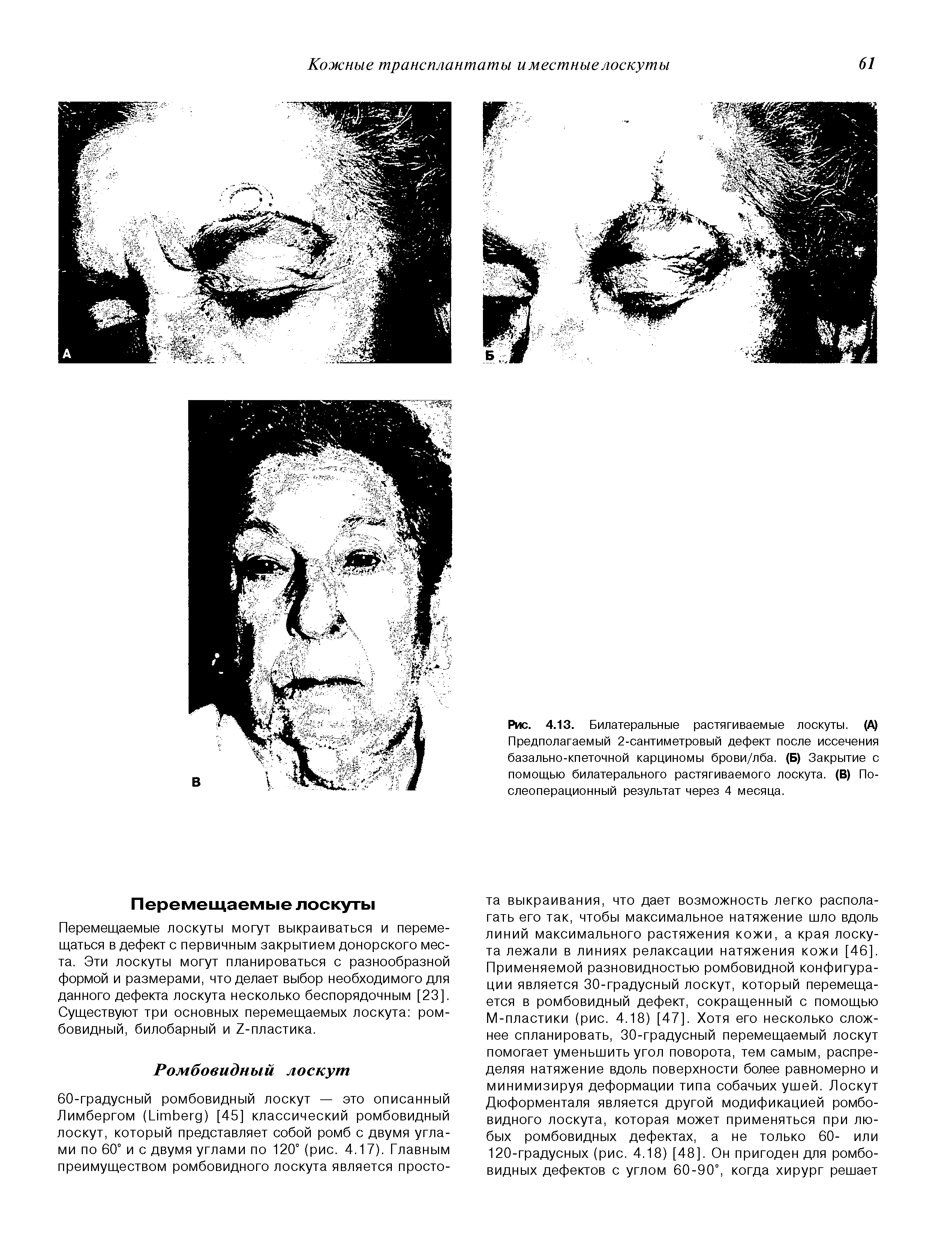 Рис. 4.13. Билатеральные растягиваемые лоскуты. (А) Предполагаемый 2-сантиметровый дефект после иссечения базально-кпеточной карциномы брови/лба. (Б) Закрытие с помощью билатерального растягиваемого лоскута. (В) Послеоперационный результат через 4 месяца.