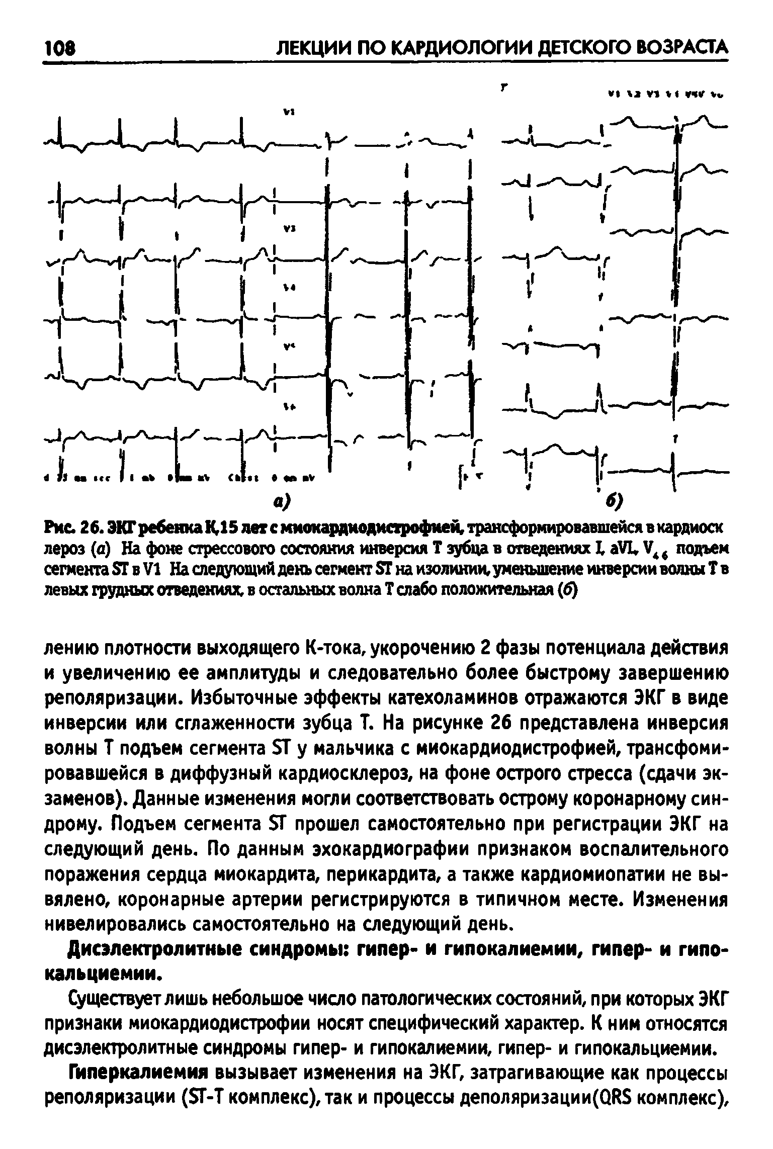 Рис. 2 6. ЭКГ ребенка К15 дет с ммокардиодистрофией, трансформировавшейся в кардиоск лероз (а) На фоне стрессового состояния инверсия Т зубца в отведениях 1, аУ1, V 4 подъем сегмента Я в VI На следующий день сегмент Я на изолинии, уменьшение инверсии волны Т в левых грудных отведениях, в остальных волна Т слабо положительная (б)...