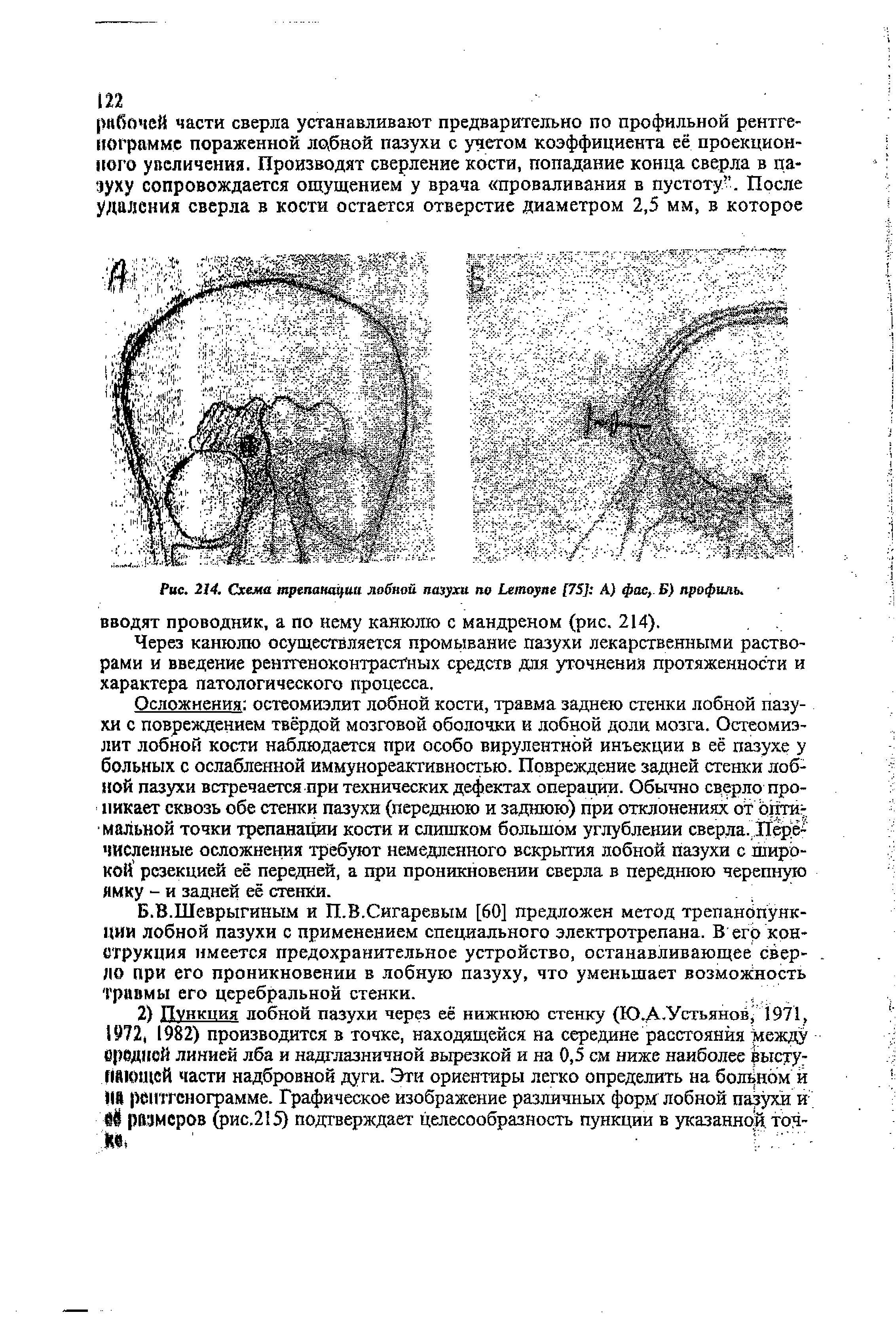 Рис. 214. Схема трепанации лобной пазухи L [75] А) фас. Б) профиль.