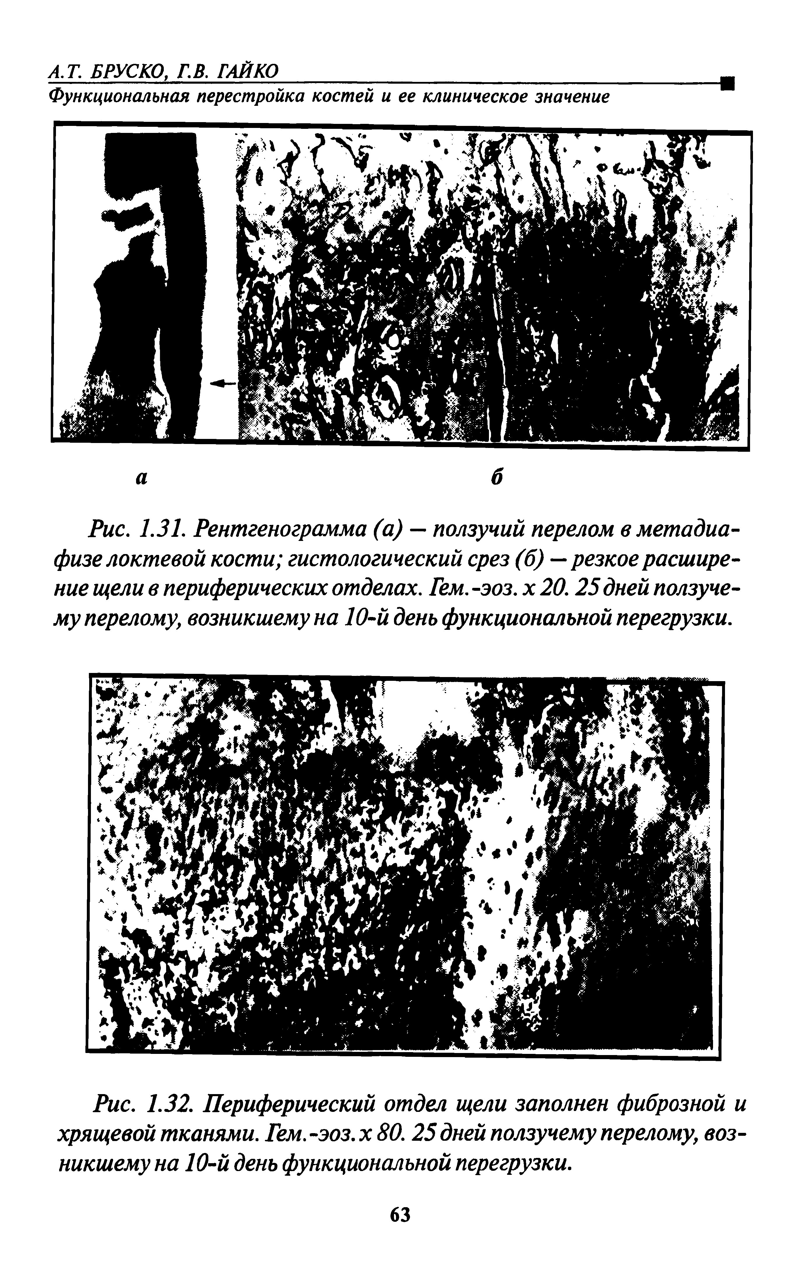 Рис. 1.31. Рентгенограмма (а) — ползучий перелом в метадиафизе локтевой кости гистологический срез (б)— резкое расширение щели в периферических отделах. Гем. -эоз. х 20.25дней ползучему перелому, возникшему на 10-й день функциональной перегрузки.