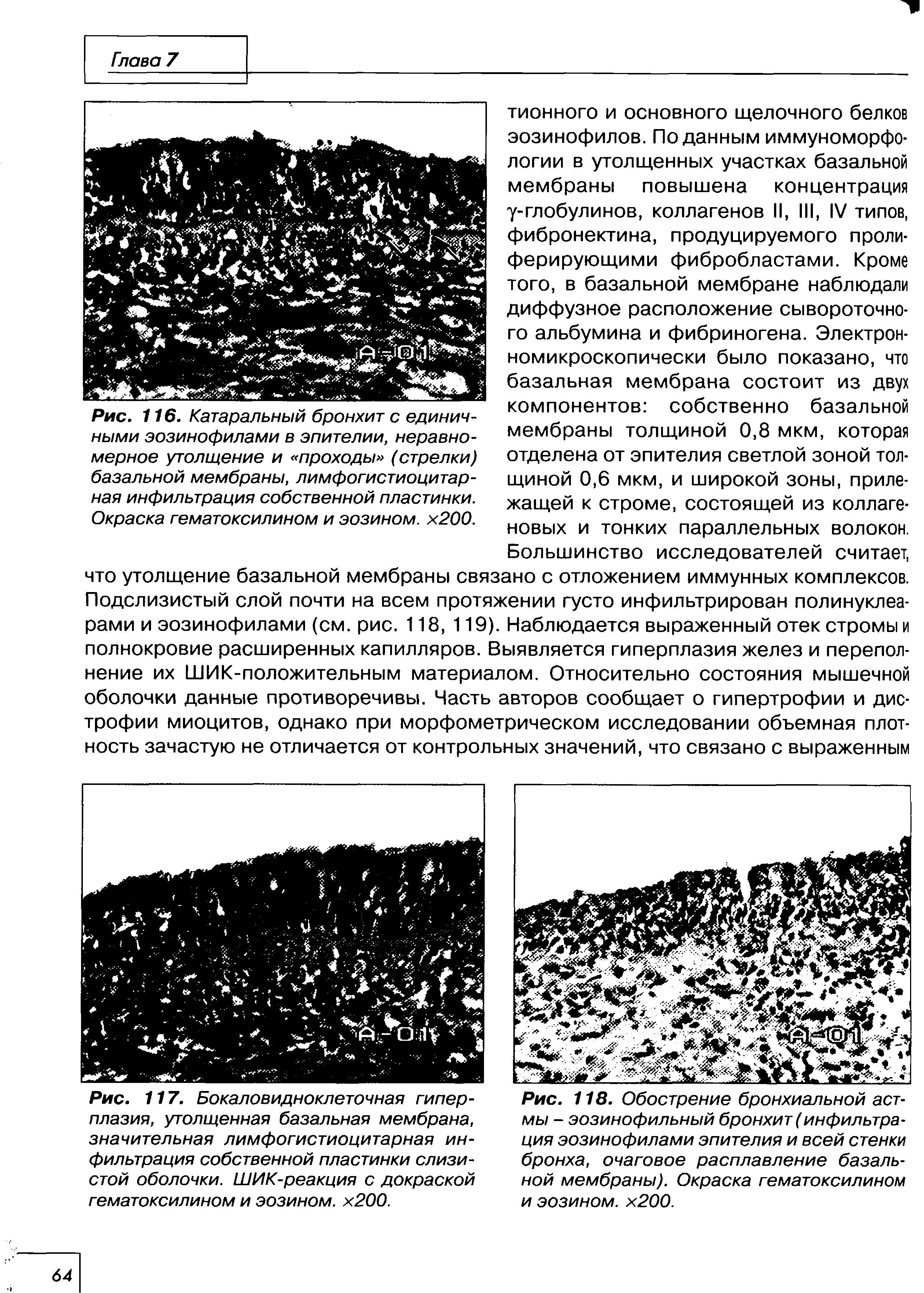 Рис. 118. Обострение бронхиальной астмы - эозинофильный бронхит (инфильтрация эозинофилами эпителия и всей стенки бронха, очаговое расплавление базальной мембраны). Окраска гематоксилином и эозином. х200.