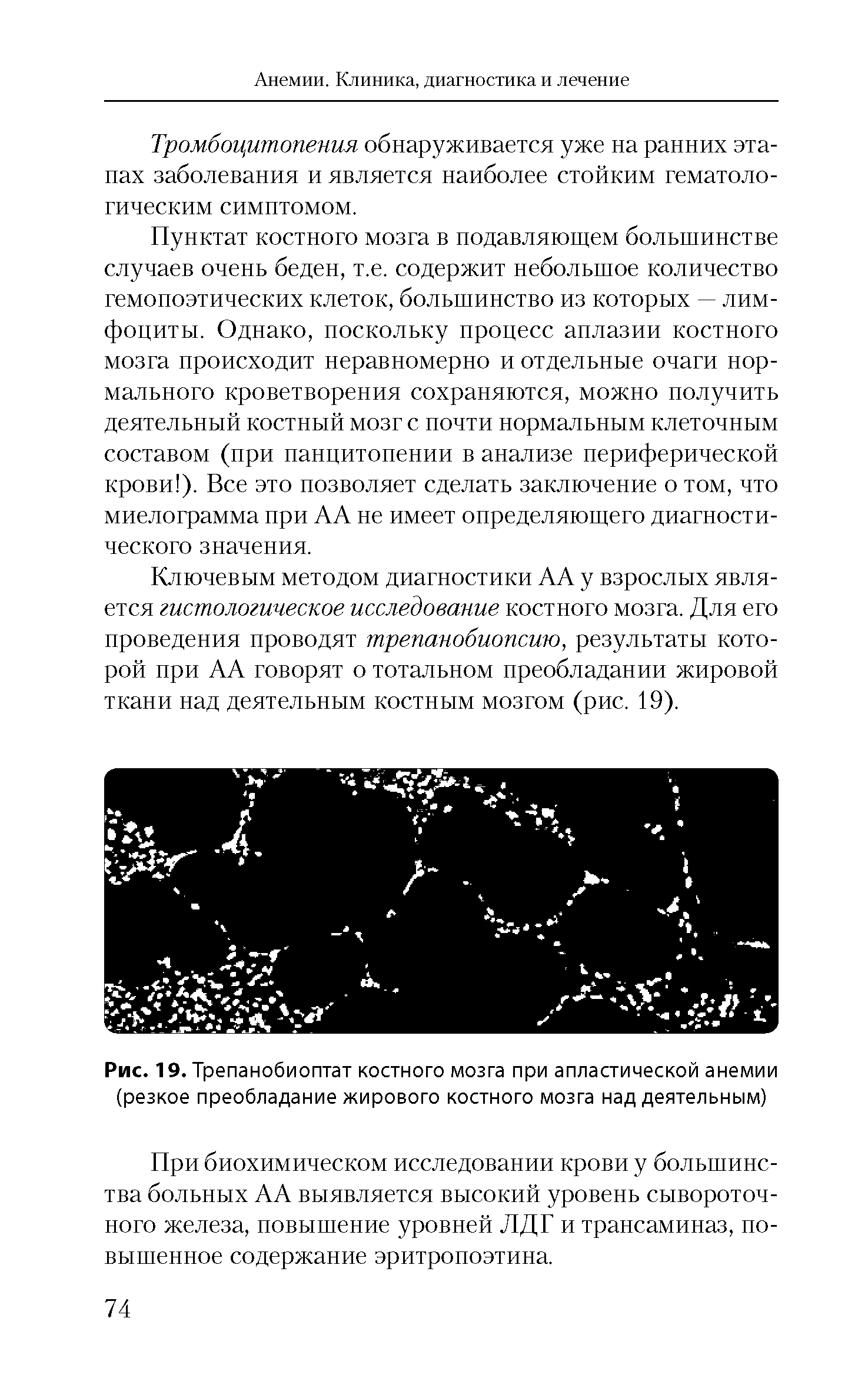 Рис. 19. Трепанобиоптат костного мозга при апластической анемии (резкое преобладание жирового костного мозга над деятельным)...