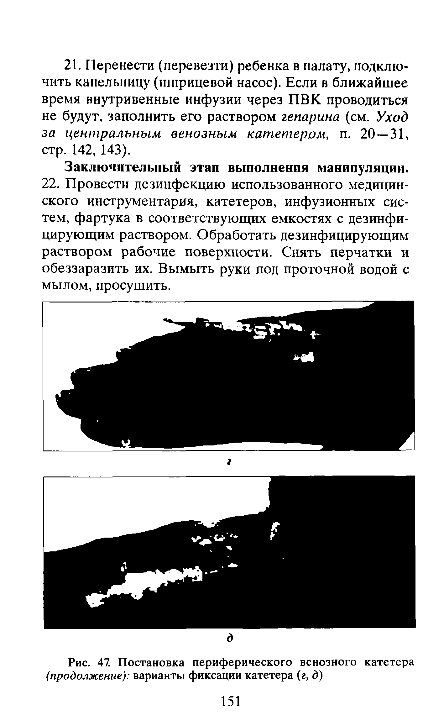 Рис. 47. Постановка периферического венозного катетера (продолжение) варианты фиксации катетера (г, д)...