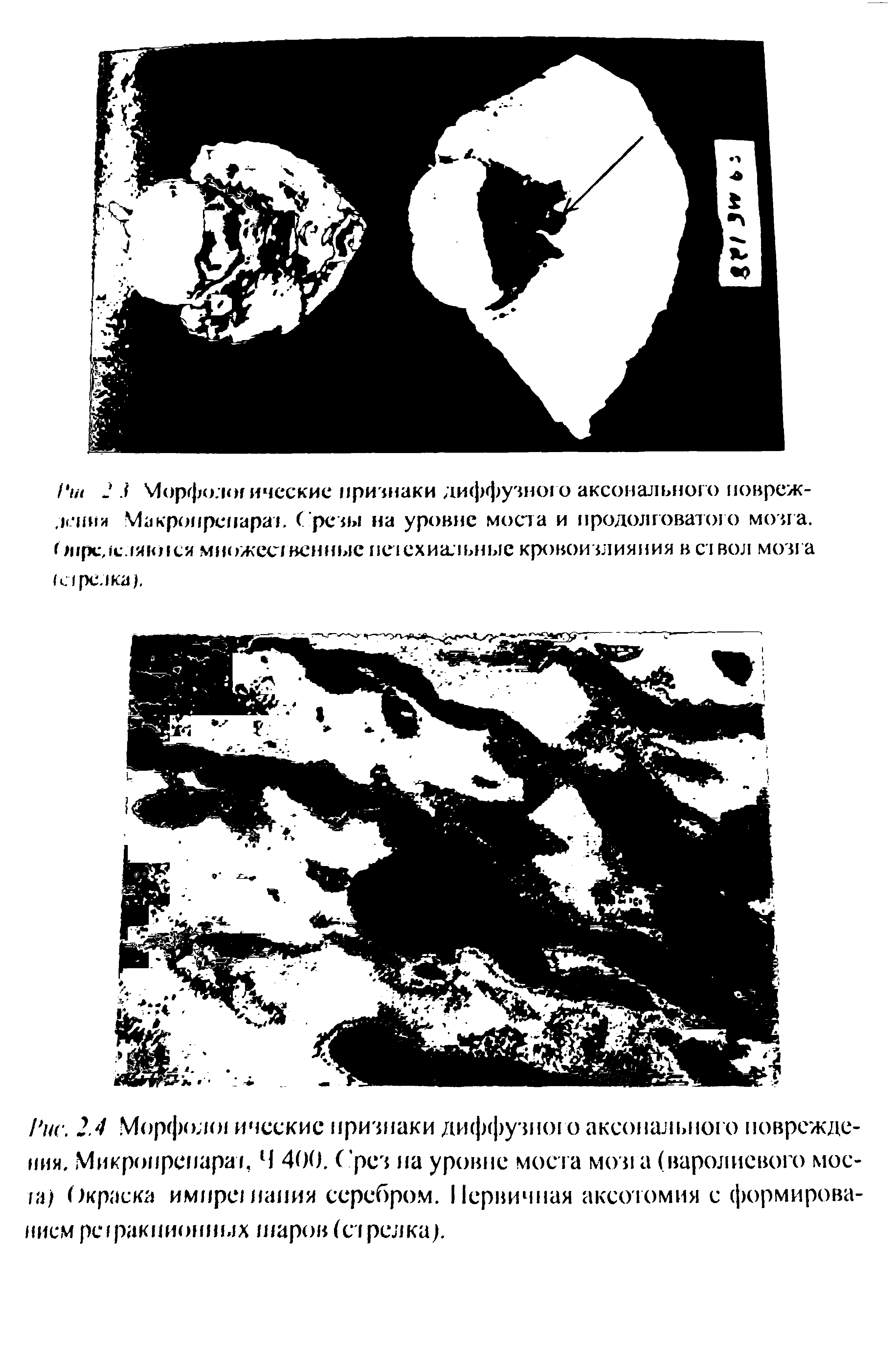 Рис. 2.4 Морфолш ическис признаки диффузного аксонального повреждения, Микропрепарат, Ч 400. С рез на уровне мост а мозга (варолнового моста/ Окраска имлре лания серебром. Первичная аксотомия с формированием рсгракпионных шаров (стрелка).