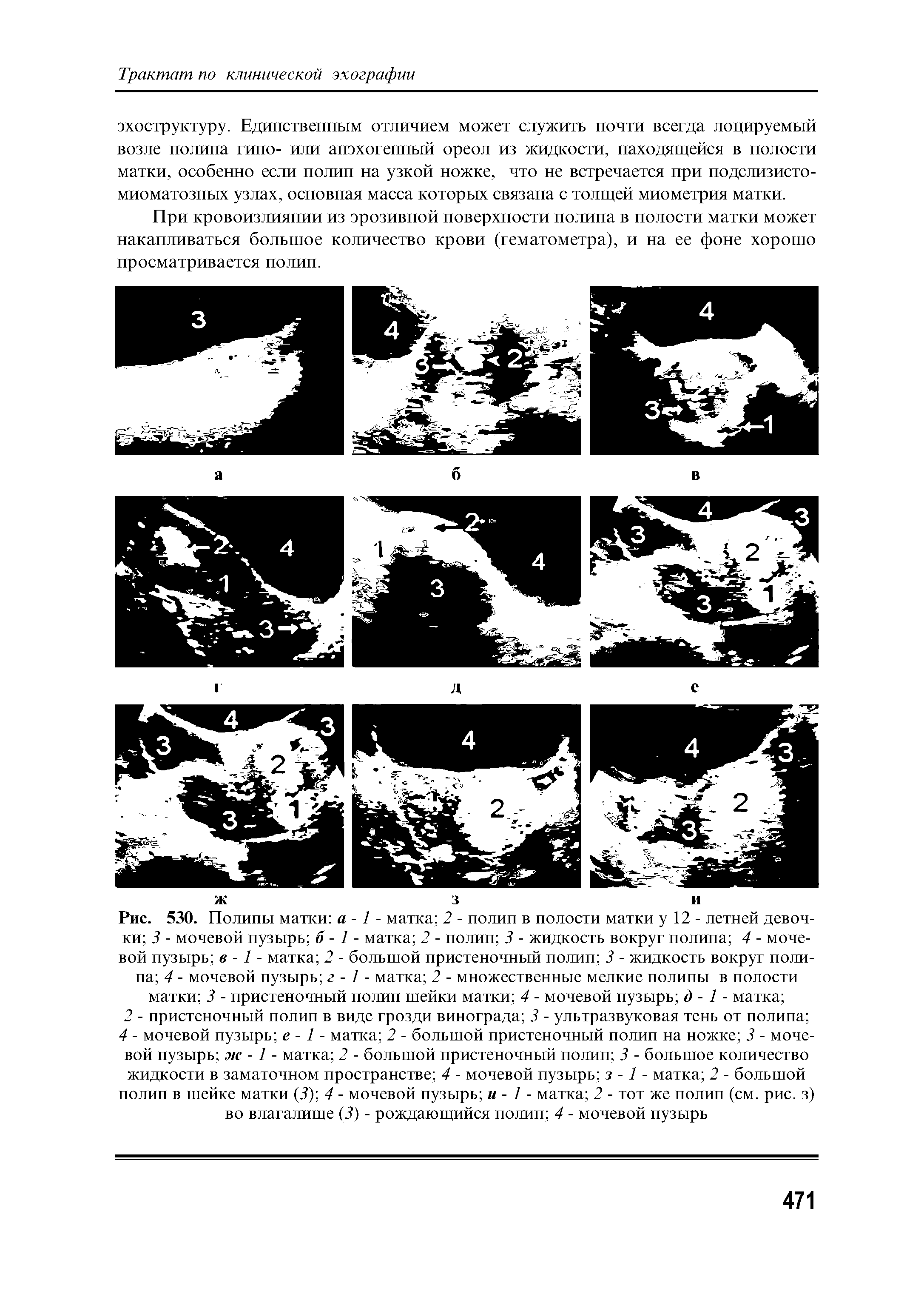 Рис. 530. Полипы матки а -1 - матка 2 - полип в полости матки у 12 - летней девочки 3 - мочевой пузырь б - 1 - матка 2 - полип 3 - жидкость вокруг полипа 4 - мочевой пузырь в -1 - матка 2 - большой пристеночный полип 3 - жидкость вокруг полипа 4 - мочевой пузырь г -1 - матка 2 - множественные мелкие полипы в полости матки 3 - пристеночный полип шейки матки 4 - мочевой пузырь д - 1 - матка ...