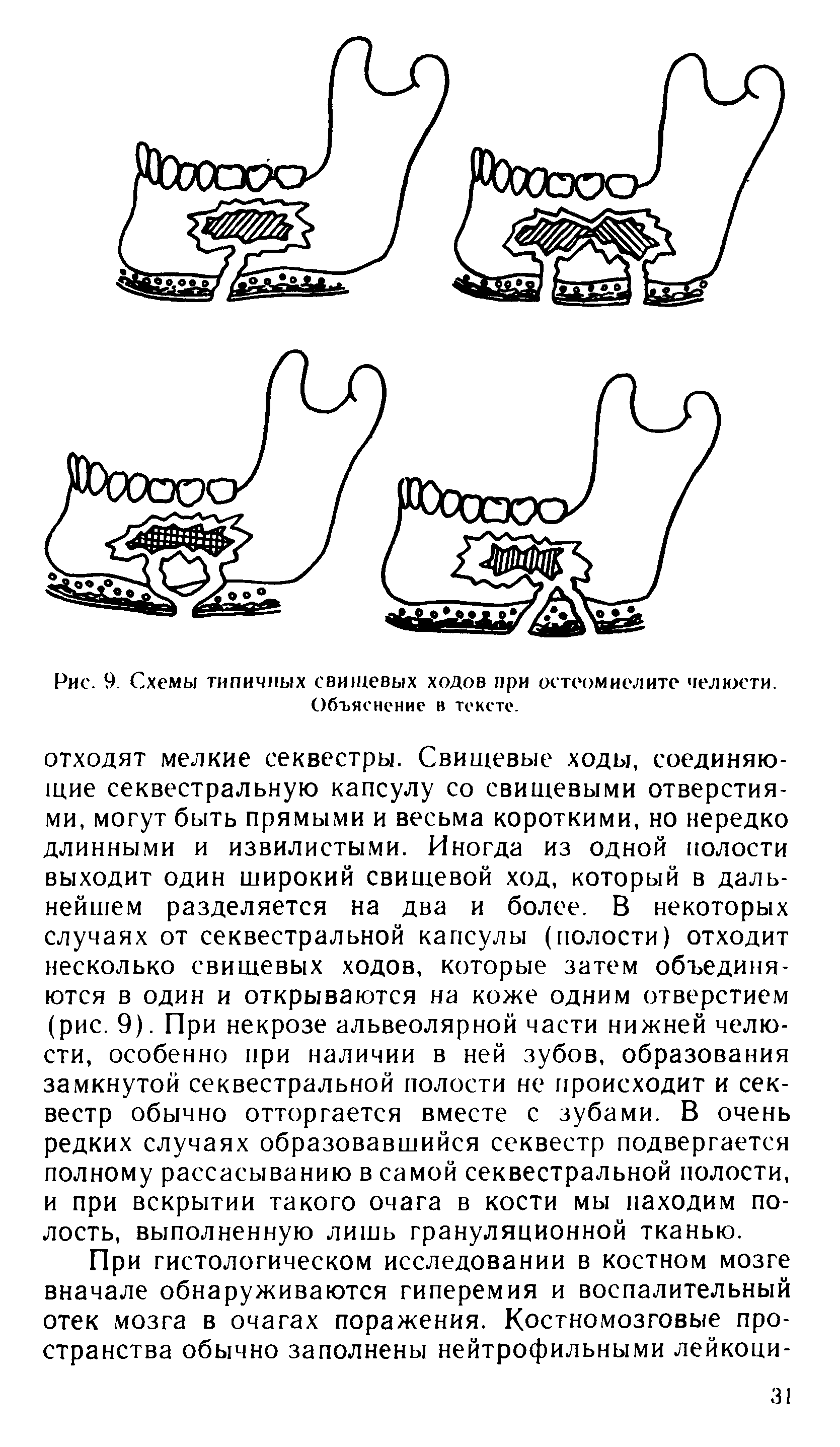 Рис. 9. Схемы типичных свищевых ходов при остеомиелите челюсти. Объяснение в тексте.