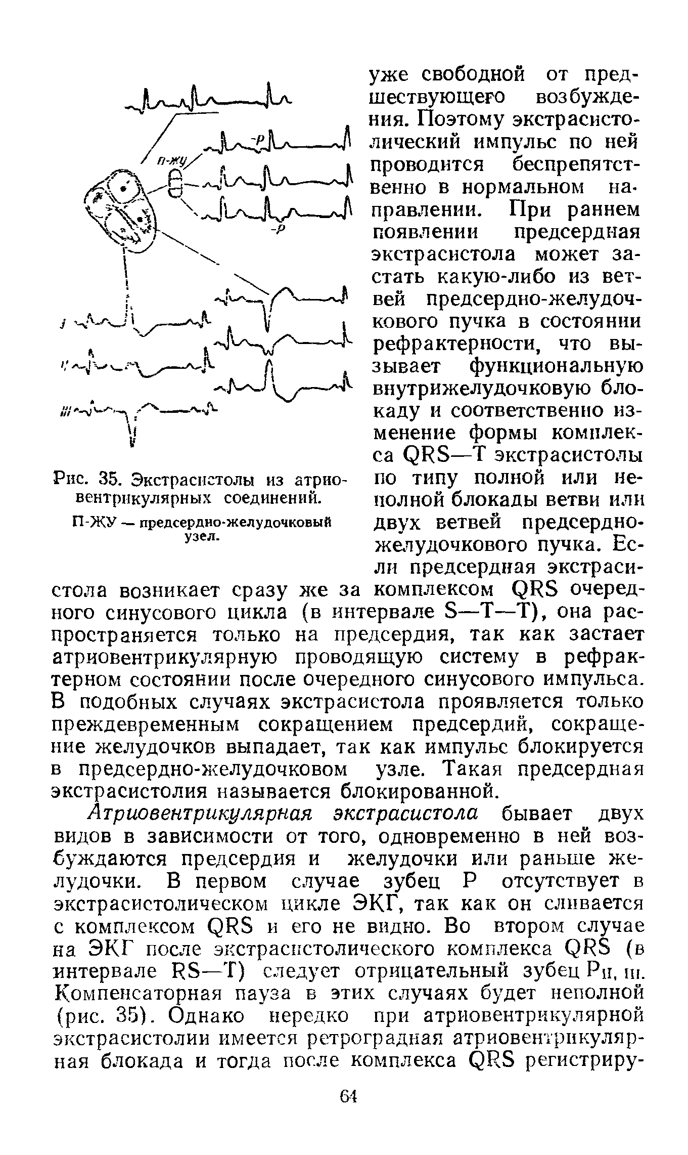 Рис. 35. Экстрасистолы из атриовентрикулярных соединений. П-ЖУ — предсердно-желудочковый узел.