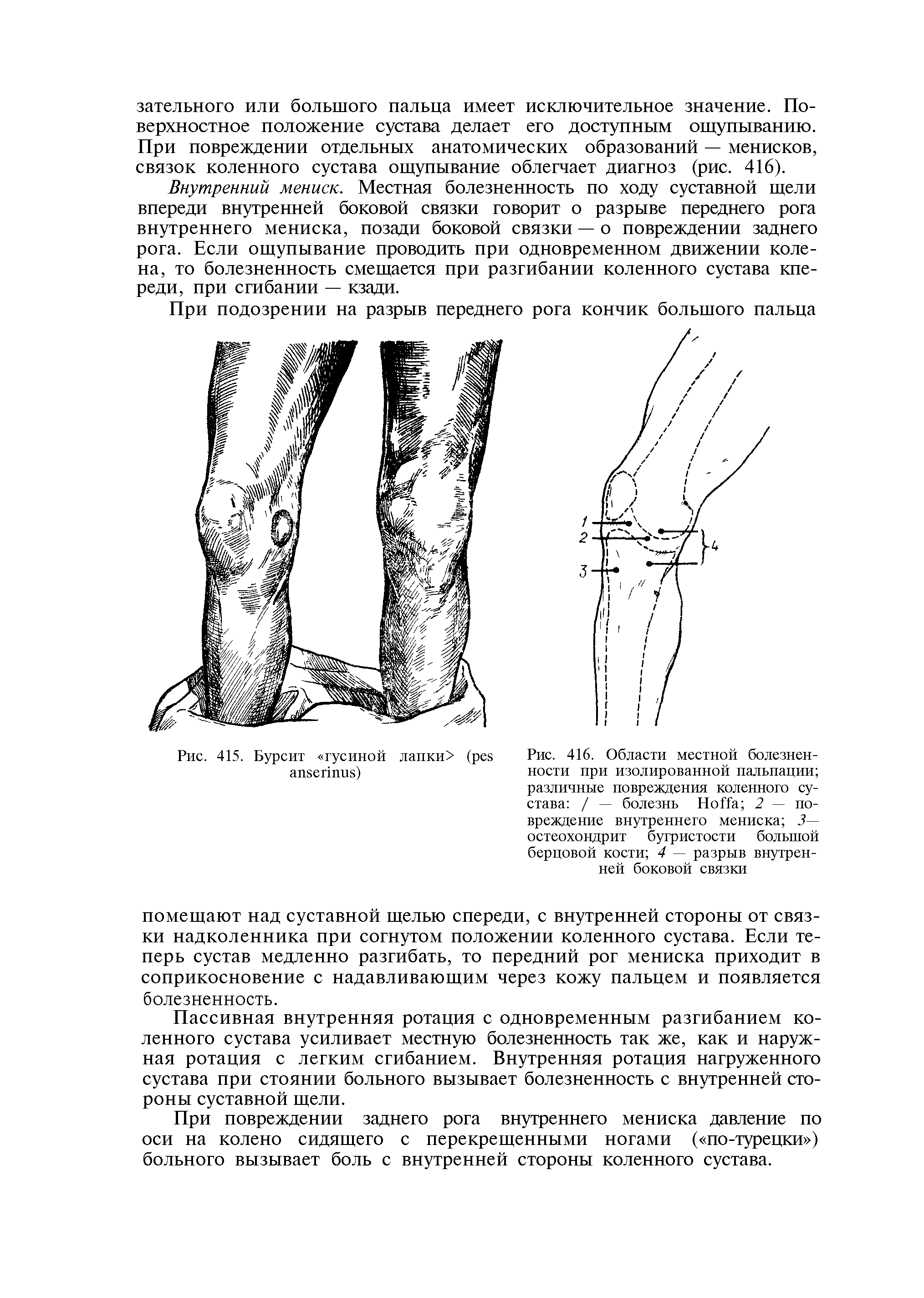 Рис. 416. Области местной болезненности при изолированной пальпации различные повреждения коленного сустава / — болезнь H 2 — повреждение внутреннего мениска 3 остеохондрит бугристости большой берцовой кости 4 — разрыв внутренней боковой связки...
