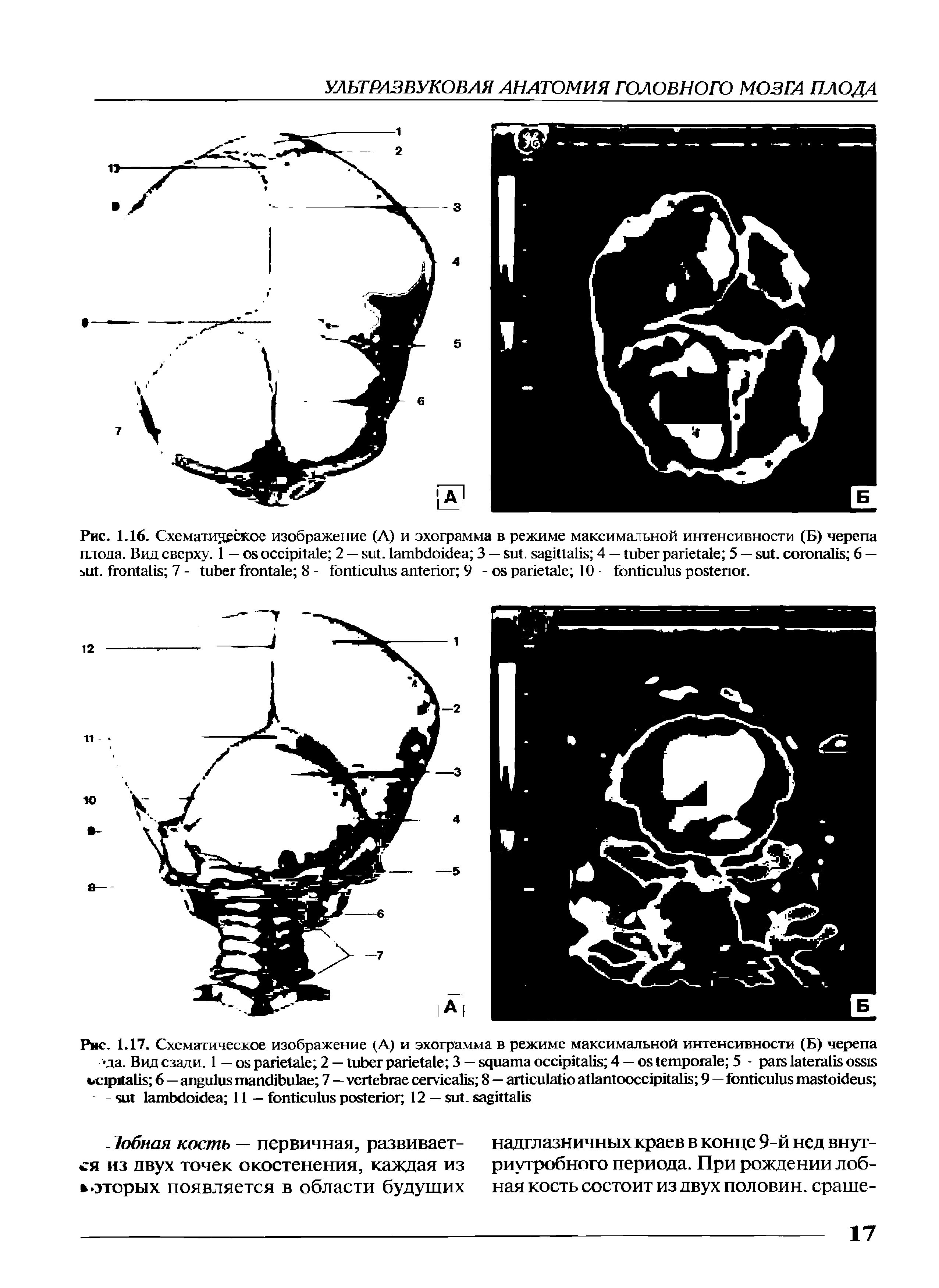 Рис. 1.16. Схематическое изображение (А) и эхограмма в режиме максимальной интенсивности (Б) черепа плода. Вид сверху. 1 - 2 — . 3 — . 4 — 5 — . 6 — . 7 - 8 - 9 - 10 .