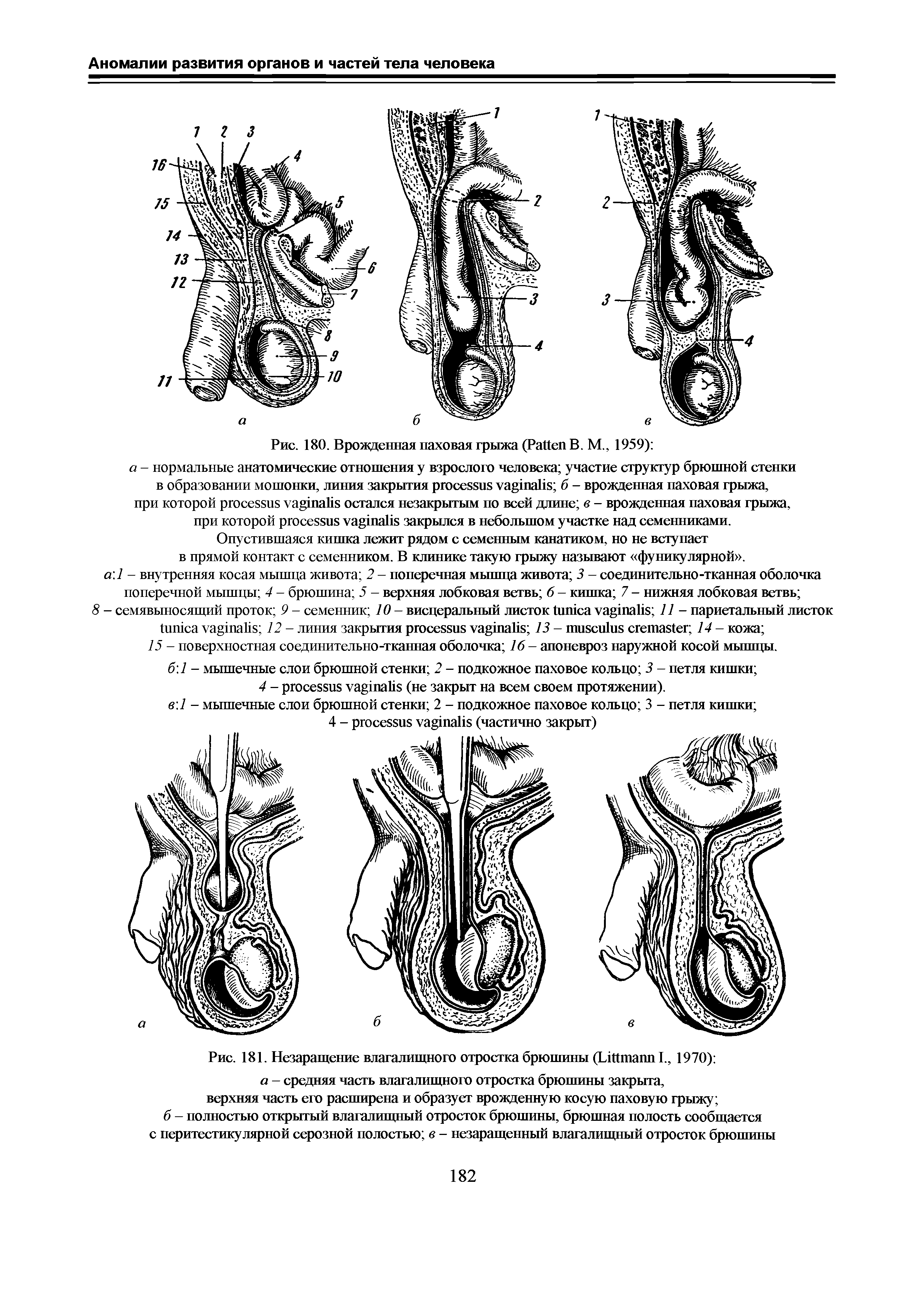 Рис. 181. Незаращение влагалищного отростка брюшины (ХлШпапп I., 1970) а - средняя часть влагалищного отростка брюшины закрыта, верхняя часть его расширена и образует врожденную косую паховую грыжу ...