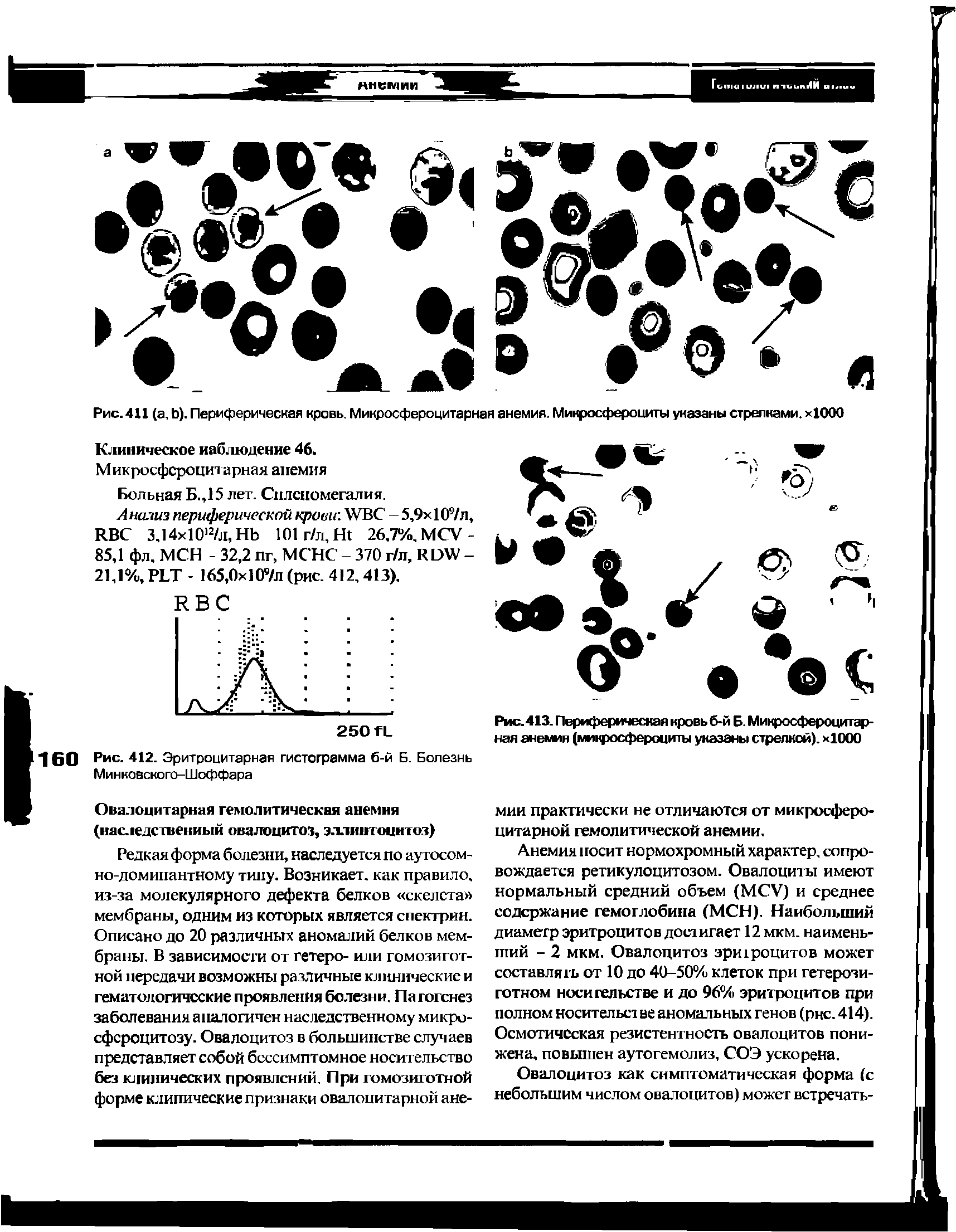 Рис.413. Периферическая кровь б-й Б. Микросфероцитарная анемия (микросфероциты указаны стрелкой). х1000...