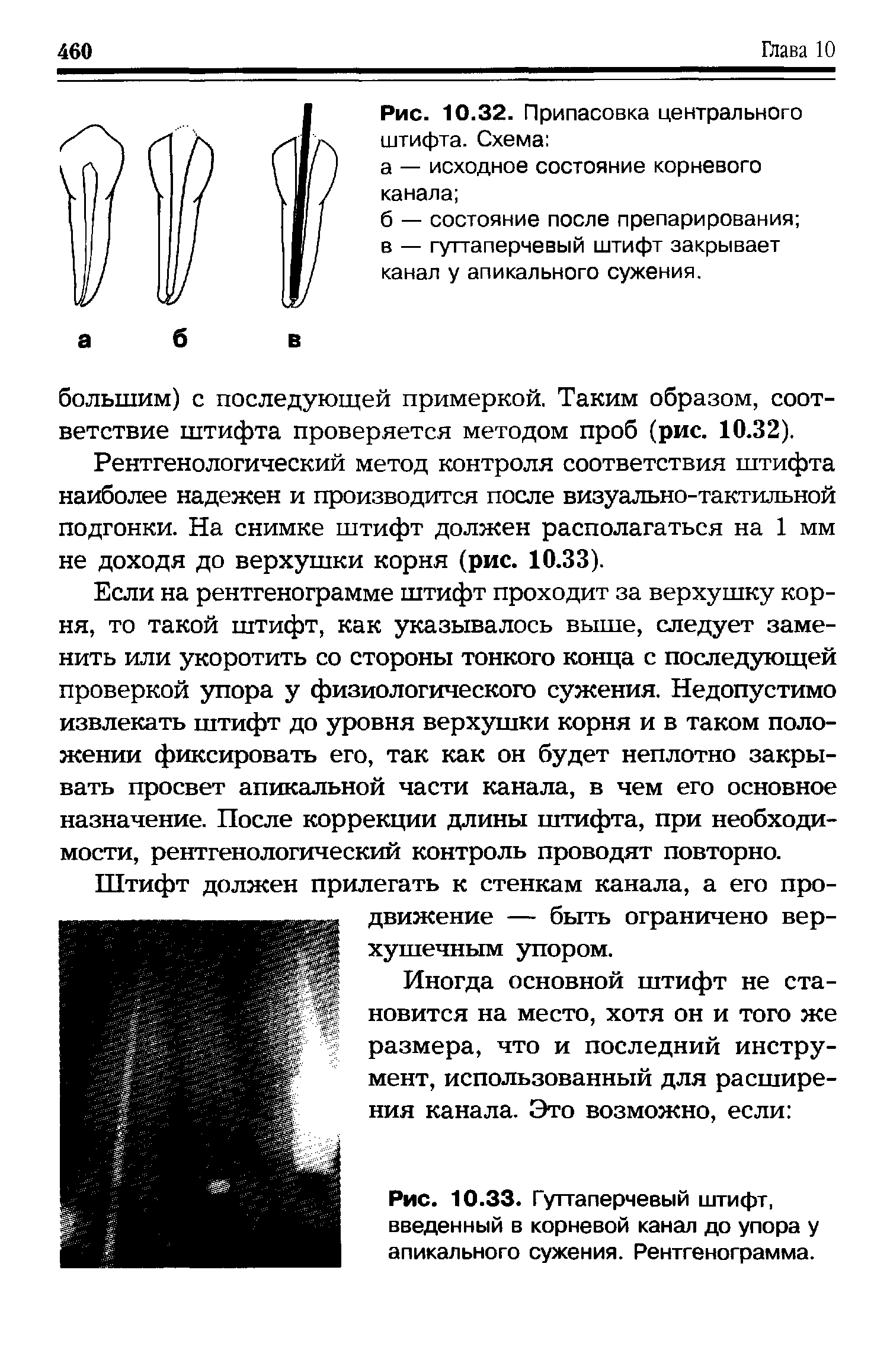 Рис. 10.33. Гуттаперчевый штифт, введенный в корневой канал до упора у апикального сужения. Рентгенограмма.