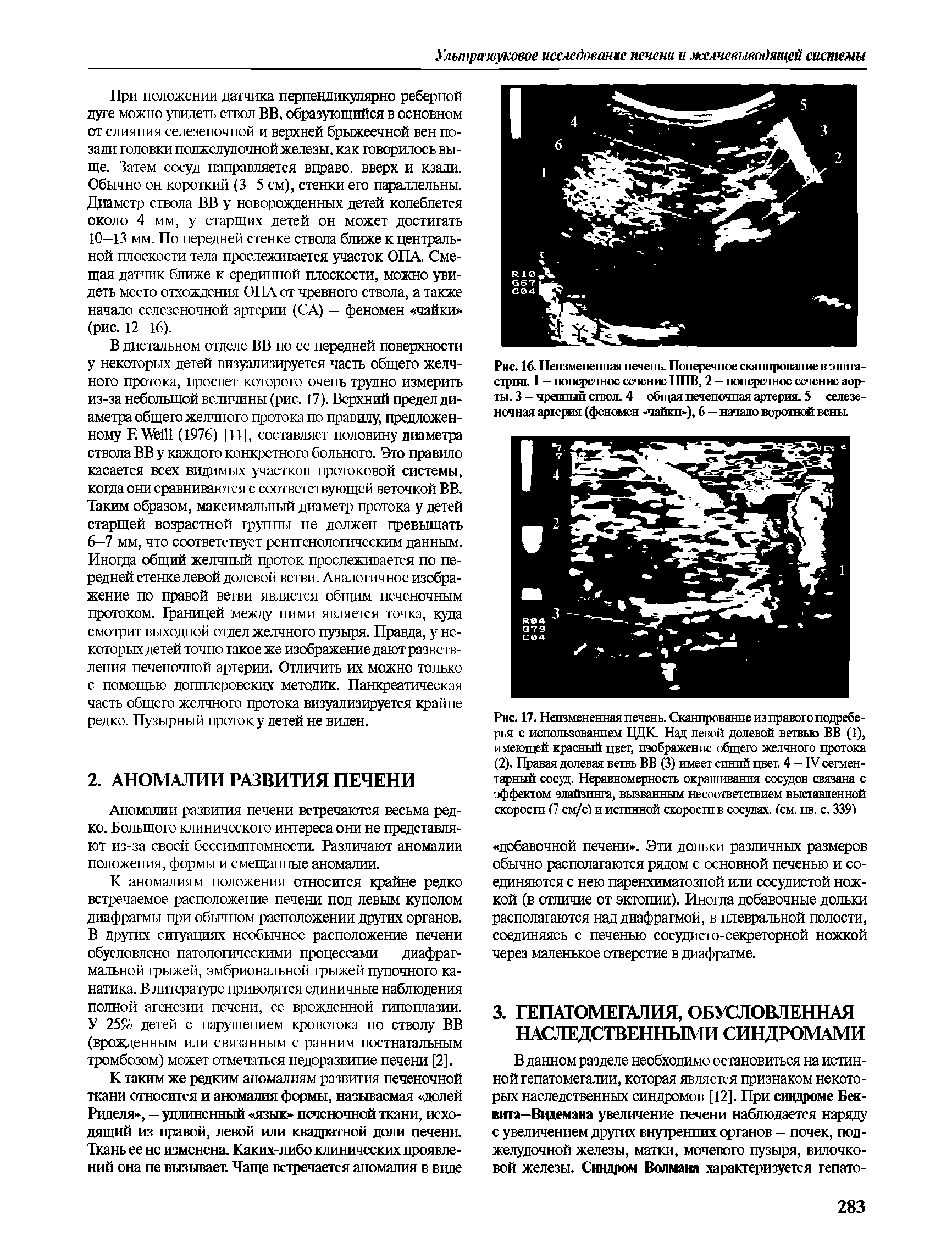 Рис. 16. Неизмененная печень. Поперечное (жанпрование в эпигастрия. 1 — поперечное сечение НПВ, 2—поперечное сечение аорты. 3 - чревный ствол. 4 — общая печеночная артерия. 5 — селезеночная артерия (феномен чайки ), 6 — начало воротной вены.