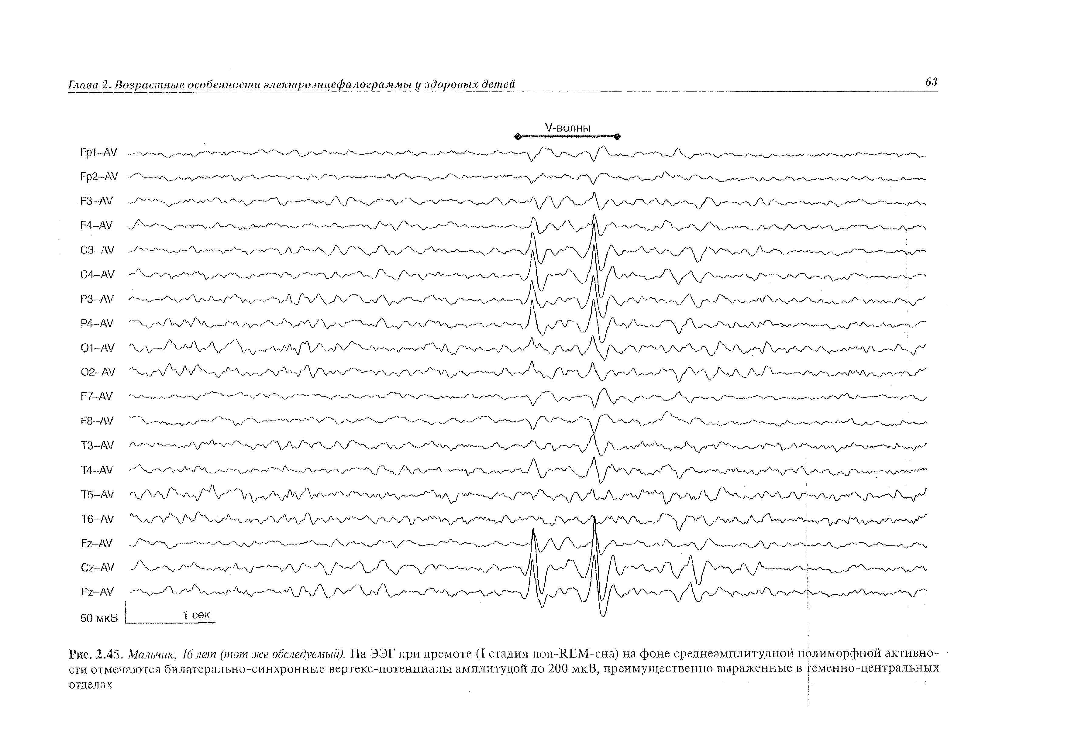 Рис. 2.45. Мальчик, 16лет (тот же обследуемый). На ЭЭГ при дремоте (I стадия -REM-сна) на фоне среднеамплитудной полиморфной активности отмечаются билатерально-синхронные вертекс-потенциалы амплитудой до 200 мкВ, преимущественно выраженные в ременно-центральных отделах ...