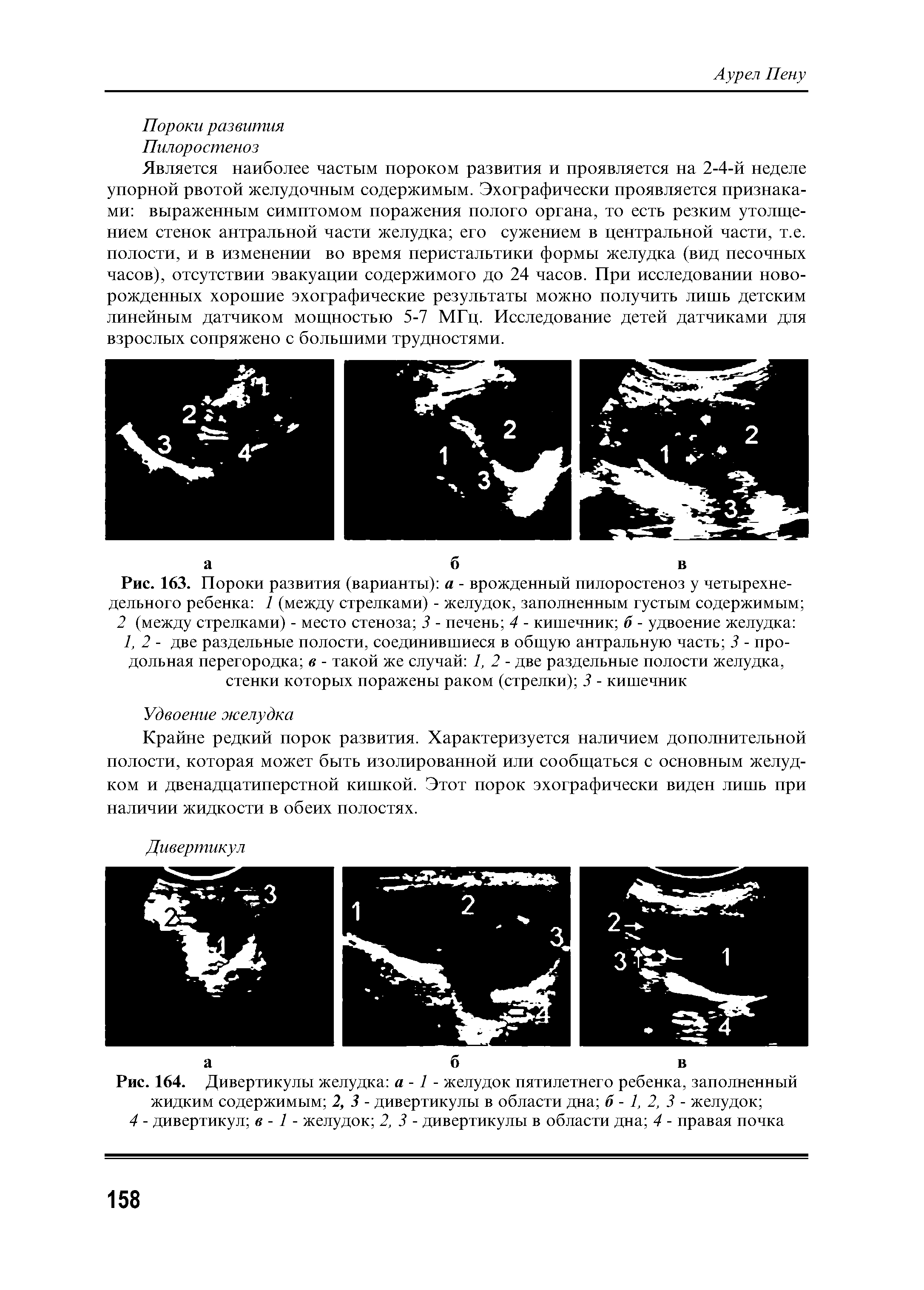 Рис. 163. Пороки развития (варианты) а - врожденный пилоростеноз у четырехнедельного ребенка 1 (между стрелками) - желудок, заполненным густым содержимым ...