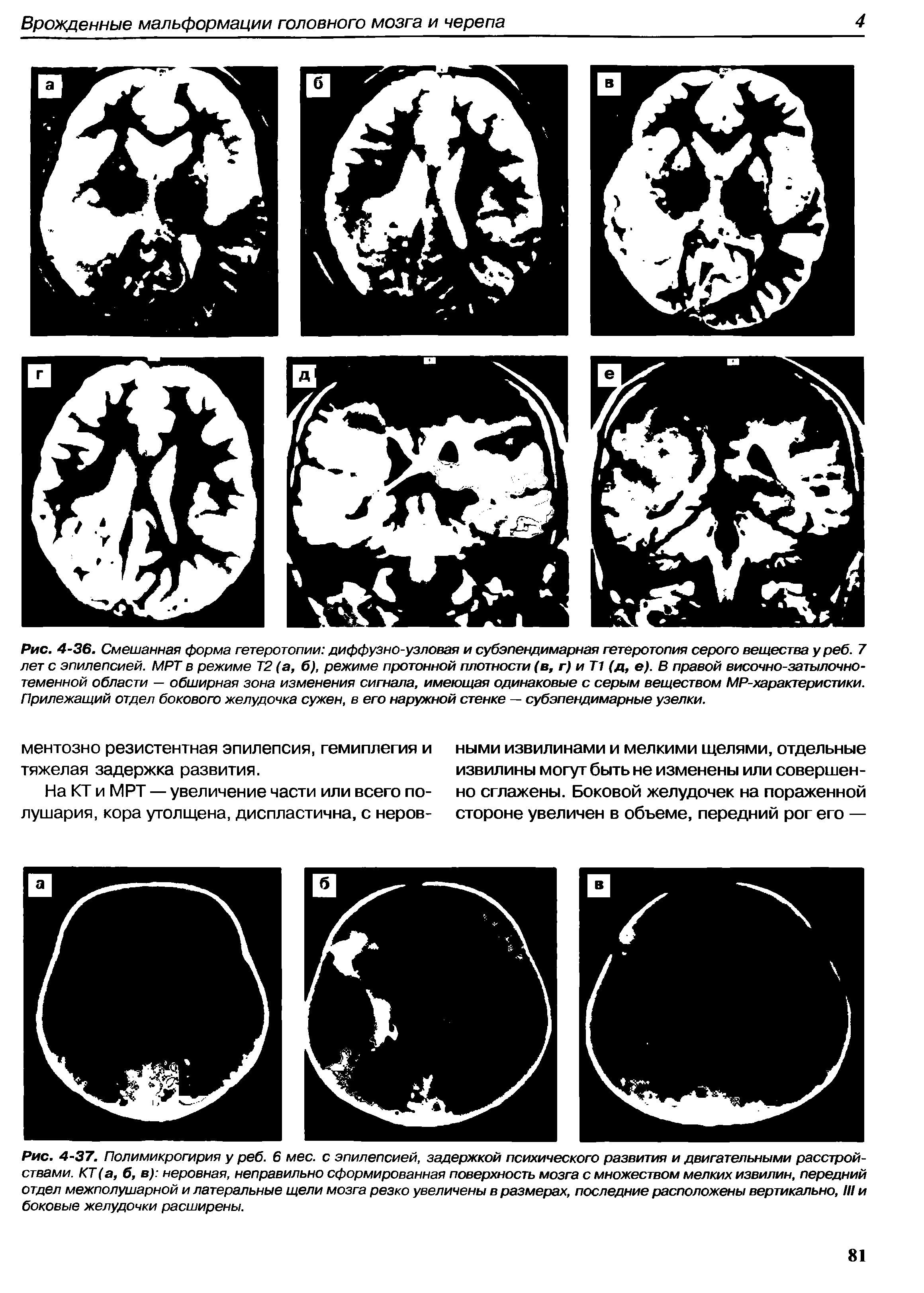 Рис. 4-37. Полимикрогирия у реб. 6 мес. с эпилепсией, задержкой психического развития и двигательными расстройствами. КТ(а, б, в) неровная, неправильно сформированная поверхность мозга с множеством мелких извилин, передний отдел межполушарной и латеральные щели мозга резко увеличены в размерах, последние расположены вертикально, III и боковые желудочки расширены.