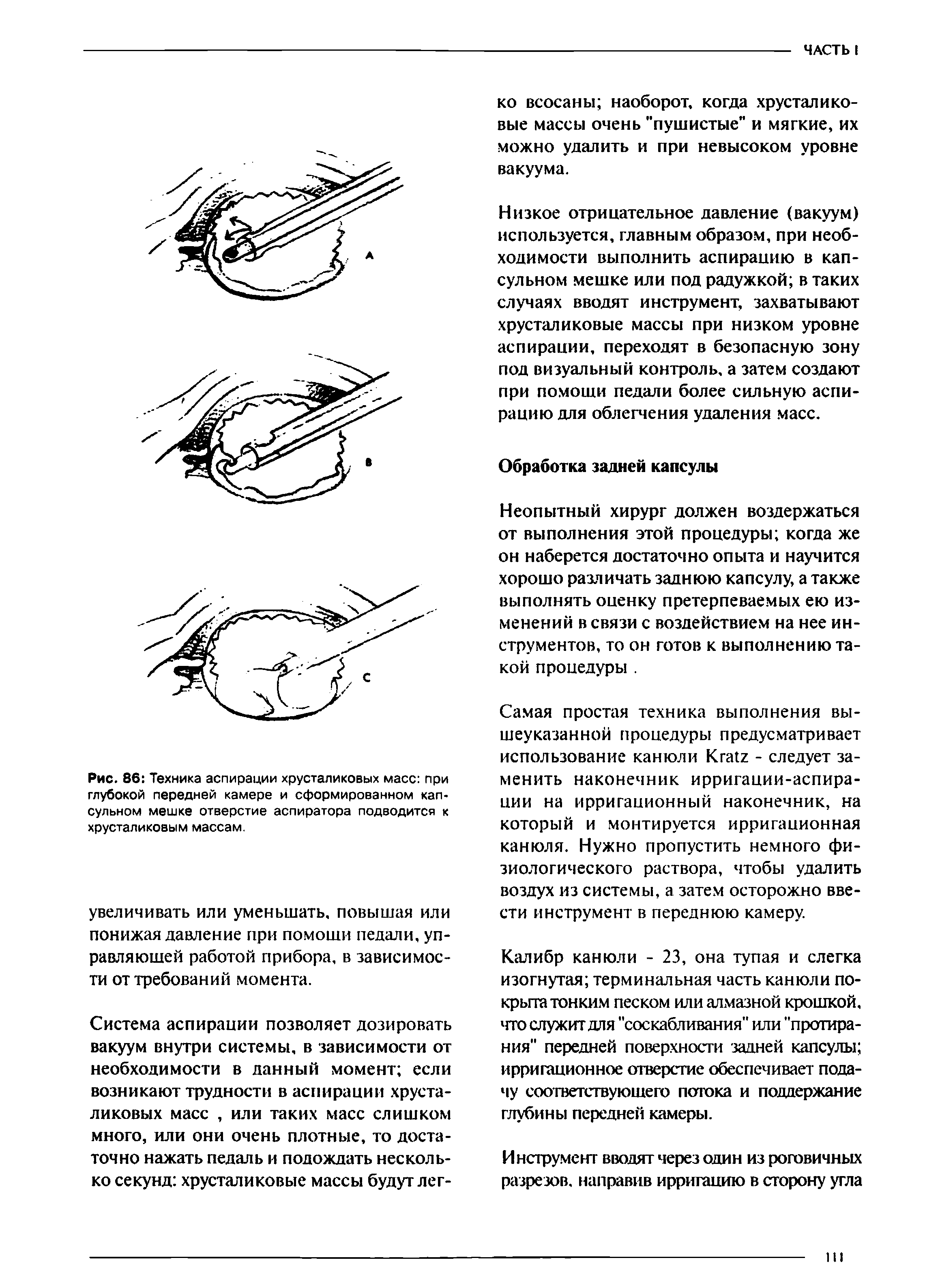 Рис. 86 Техника аспирации хрусталиковых масс при глубокой передней камере и сформированном капсульном мешке отверстие аспиратора подводится к хрусталиковым массам.