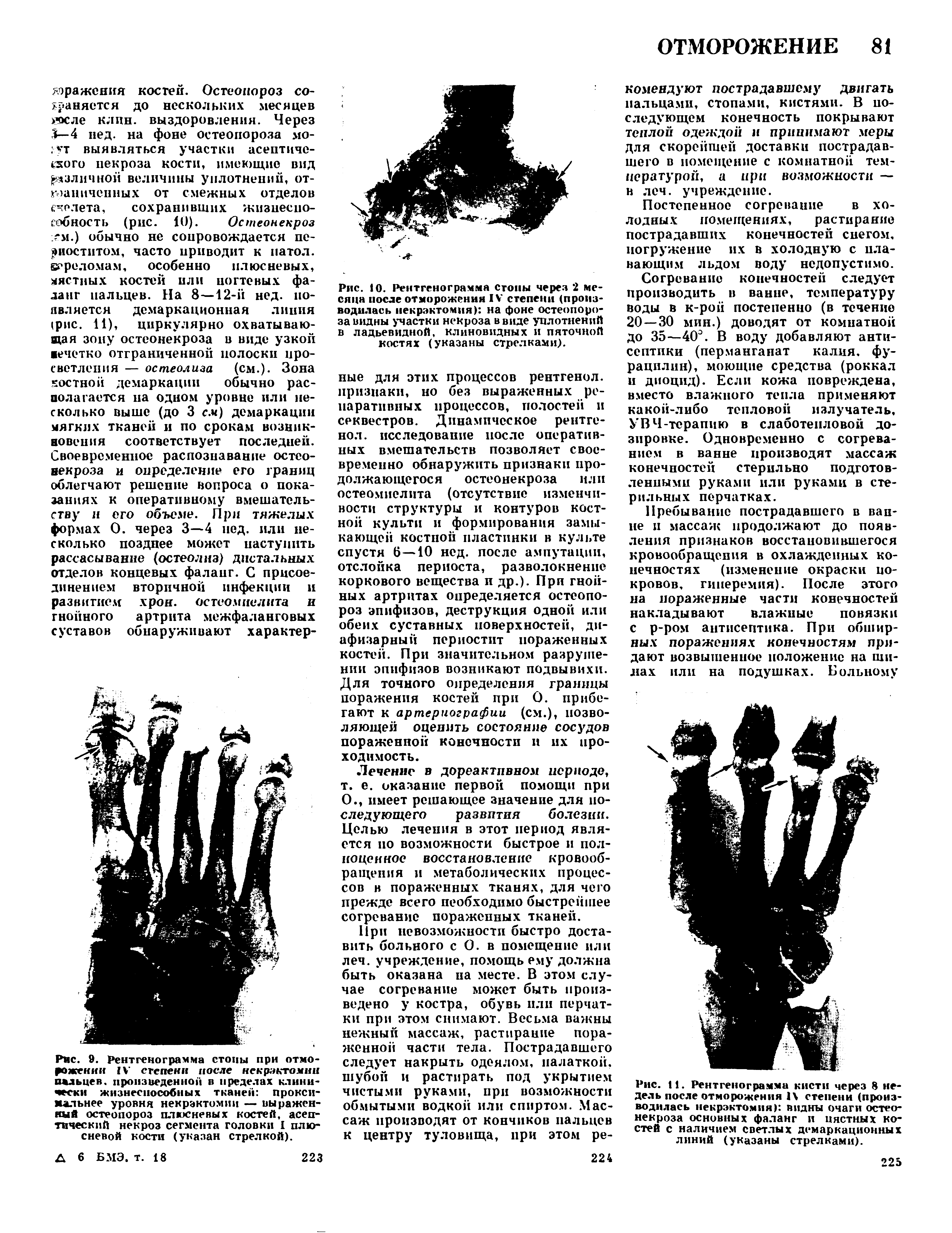 Рис. 9. Рентгенограмма стоны при отморожении IV степени после некрзктомни пальцев, произведенной в пределах клинически жизнеспособных тканей проксимальнее уровня некрэктомии — выраженный остеопороз плюсневых костей, асептический некроз сегмента головки I плюсневой кости (указан стрелкой).