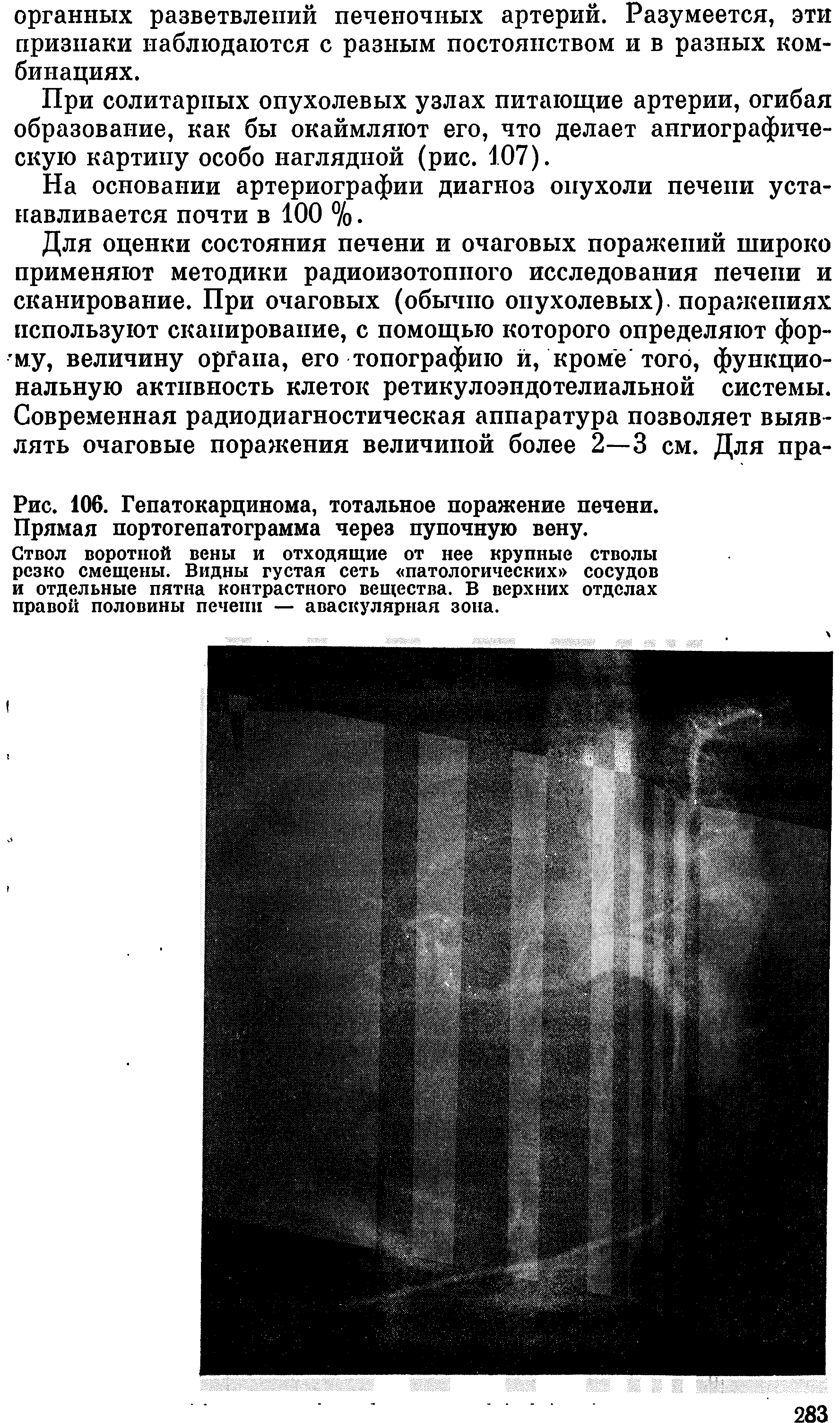 Рис. 106. Гепатокарцинома, тотальное поражение печени. Прямая портогепатограмма через пупочную вену.