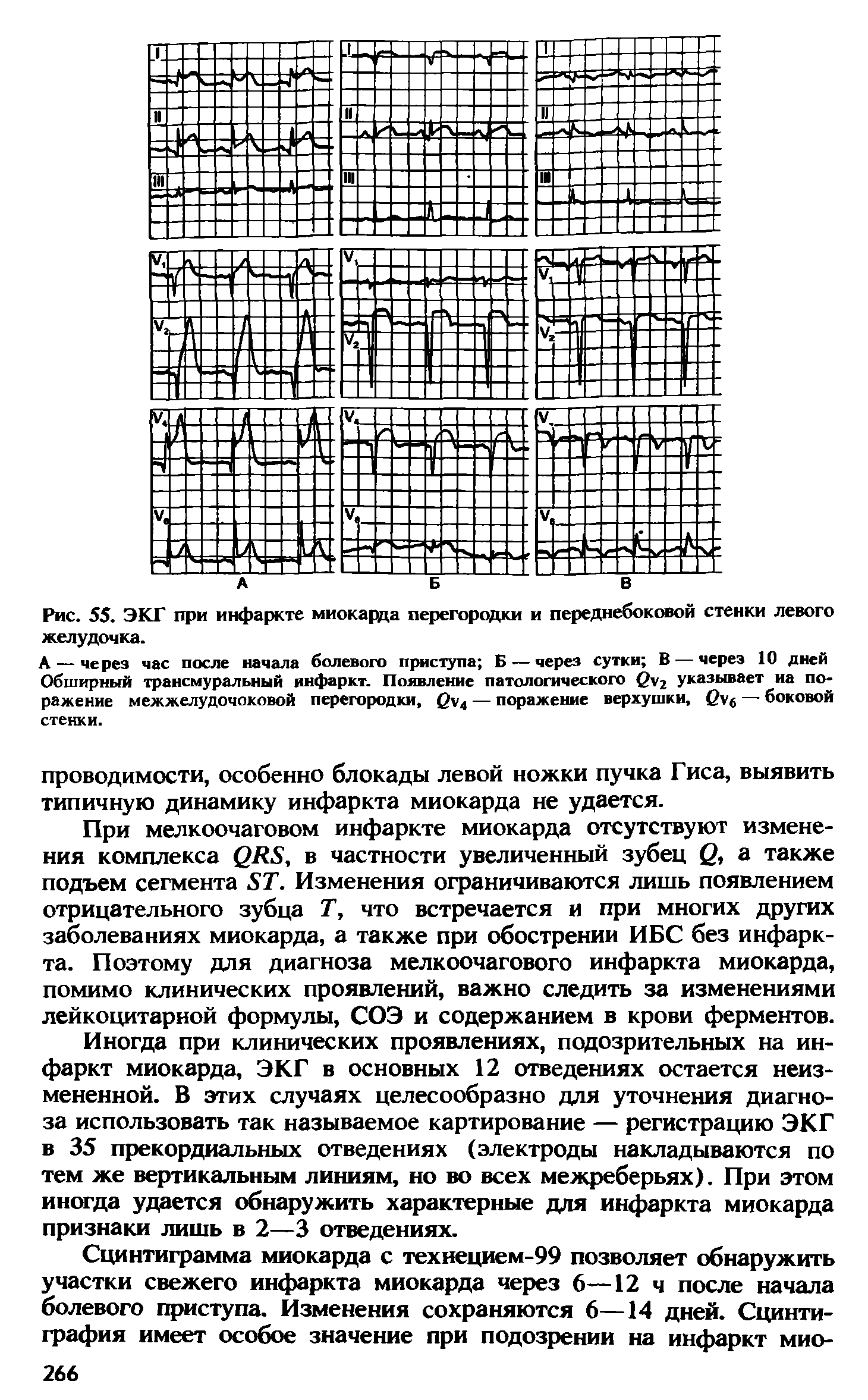 Рис. 55. ЭКГ при инфаркте миокарда перегородки и переднебоковой стенки левого желудочка.