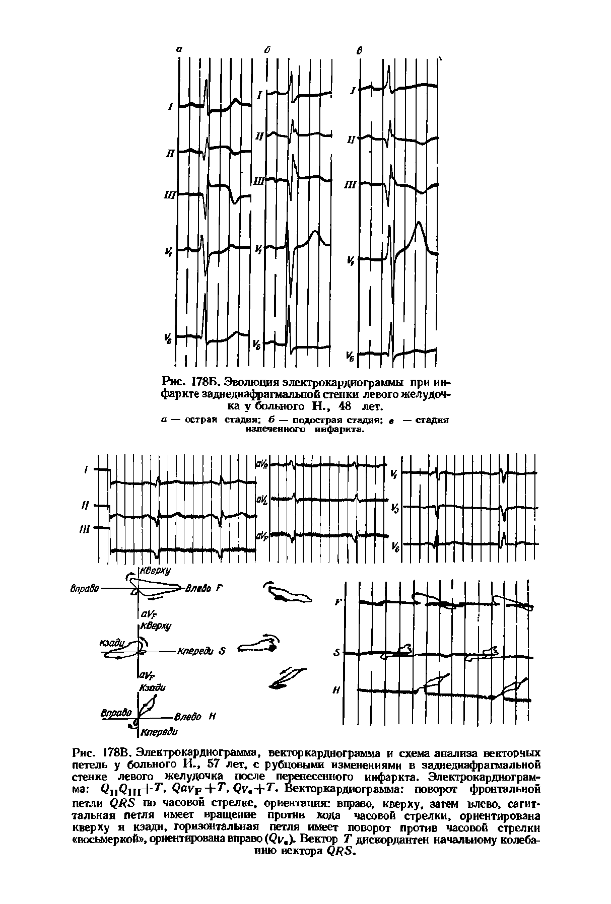 Рис. 178В. Электрокардиограмма, векторкарднограмма и схема анализа векторных петель у больного И., 57 лет, с рубцовыми изменениями в заднедиафрагмальной стенке левого желудочка после перенесенного инфаркта. Электрокардиограмма QI1QJ I+7, Q F 4-7, Векторкарднограмма поворот фронтальной...