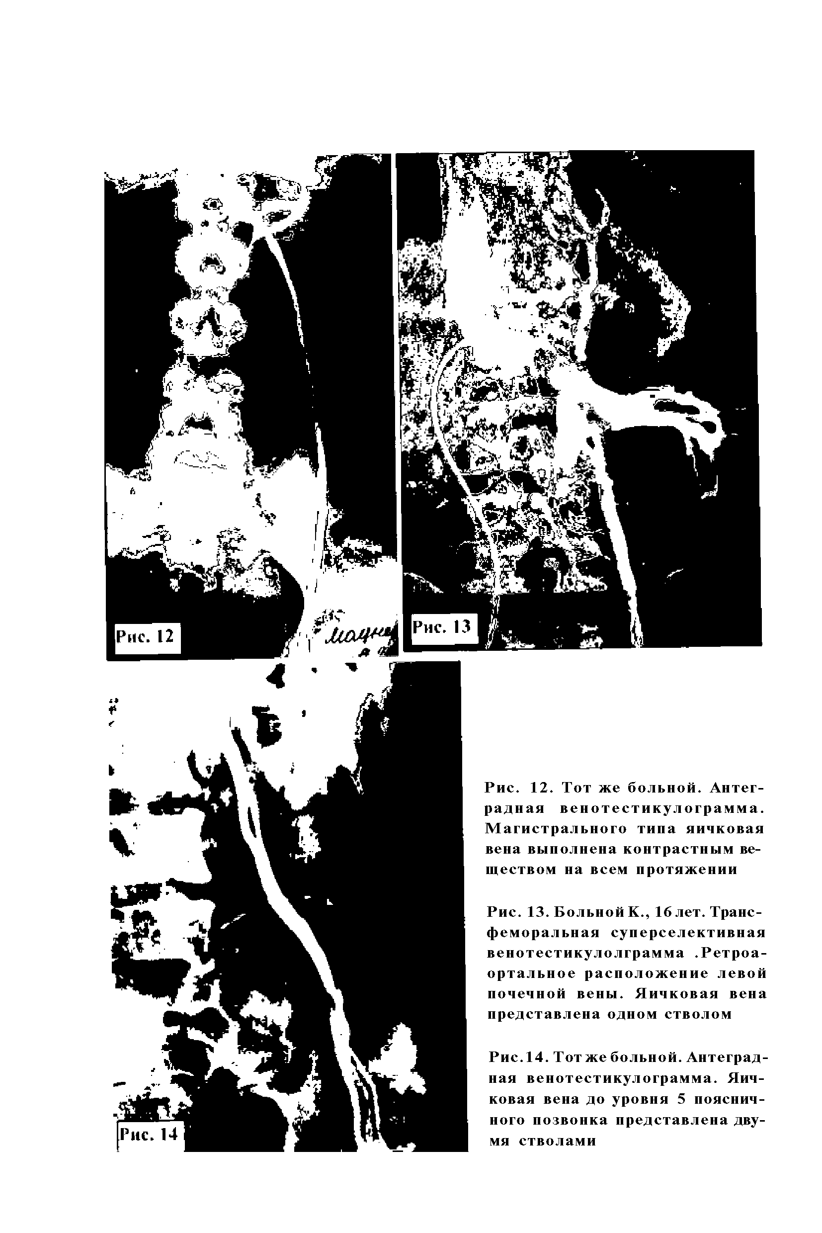 Рис. 13. Больной К., 16 лет. Трансфеморальная суперселективная венотестикулолграмма. Ретроа-ортальное расположение левой почечной вены. Яичковая вена представлена одном стволом...