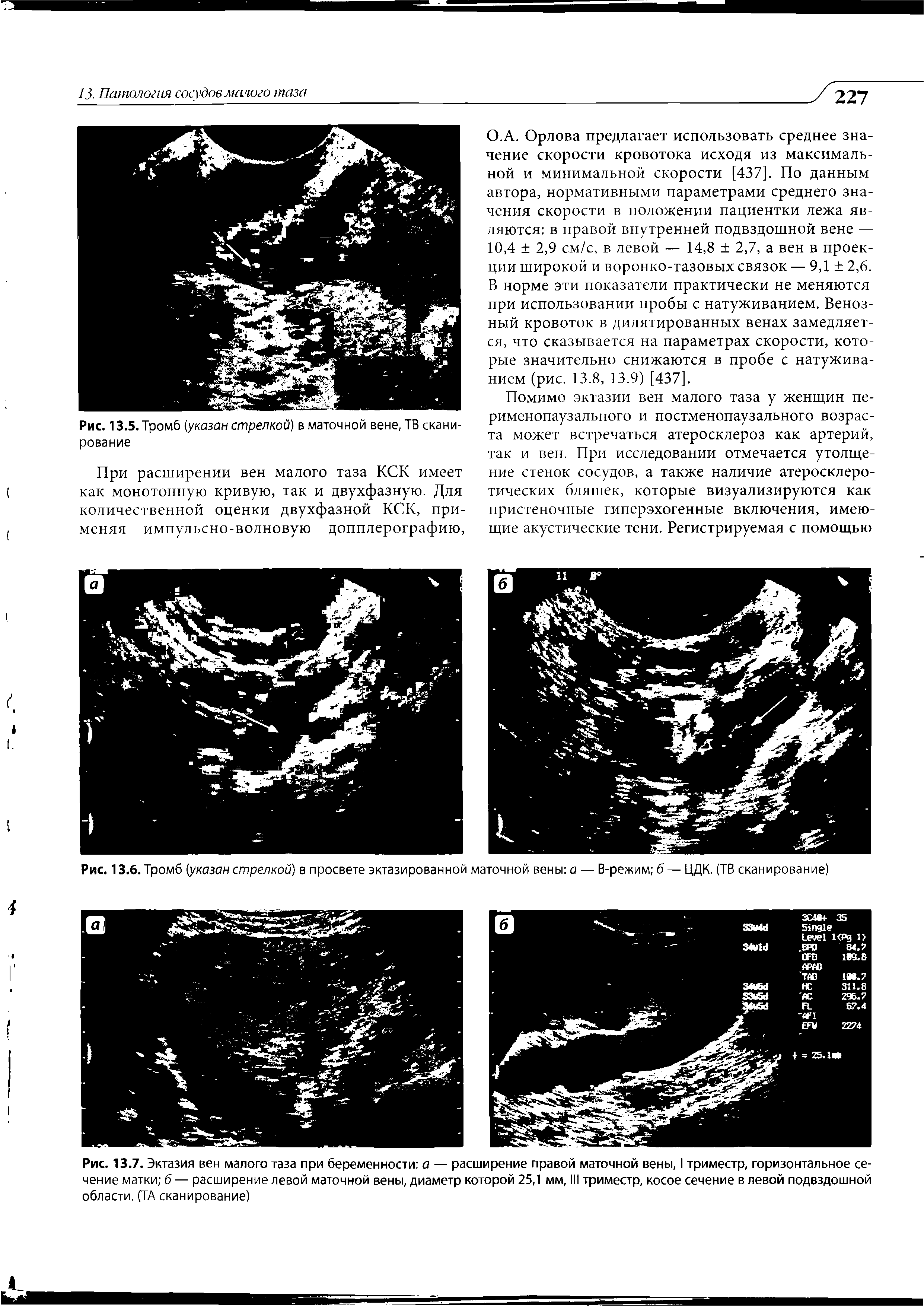 Рис. 13.7. Эктазия вен малого таза при беременности а — расширение правой маточной вены, I триместр, горизонтальное сечение матки б — расширение левой маточной вены, диаметр которой 25,1 мм, III триместр, косое сечение в левой подвздошной области. (ТА сканирование)...