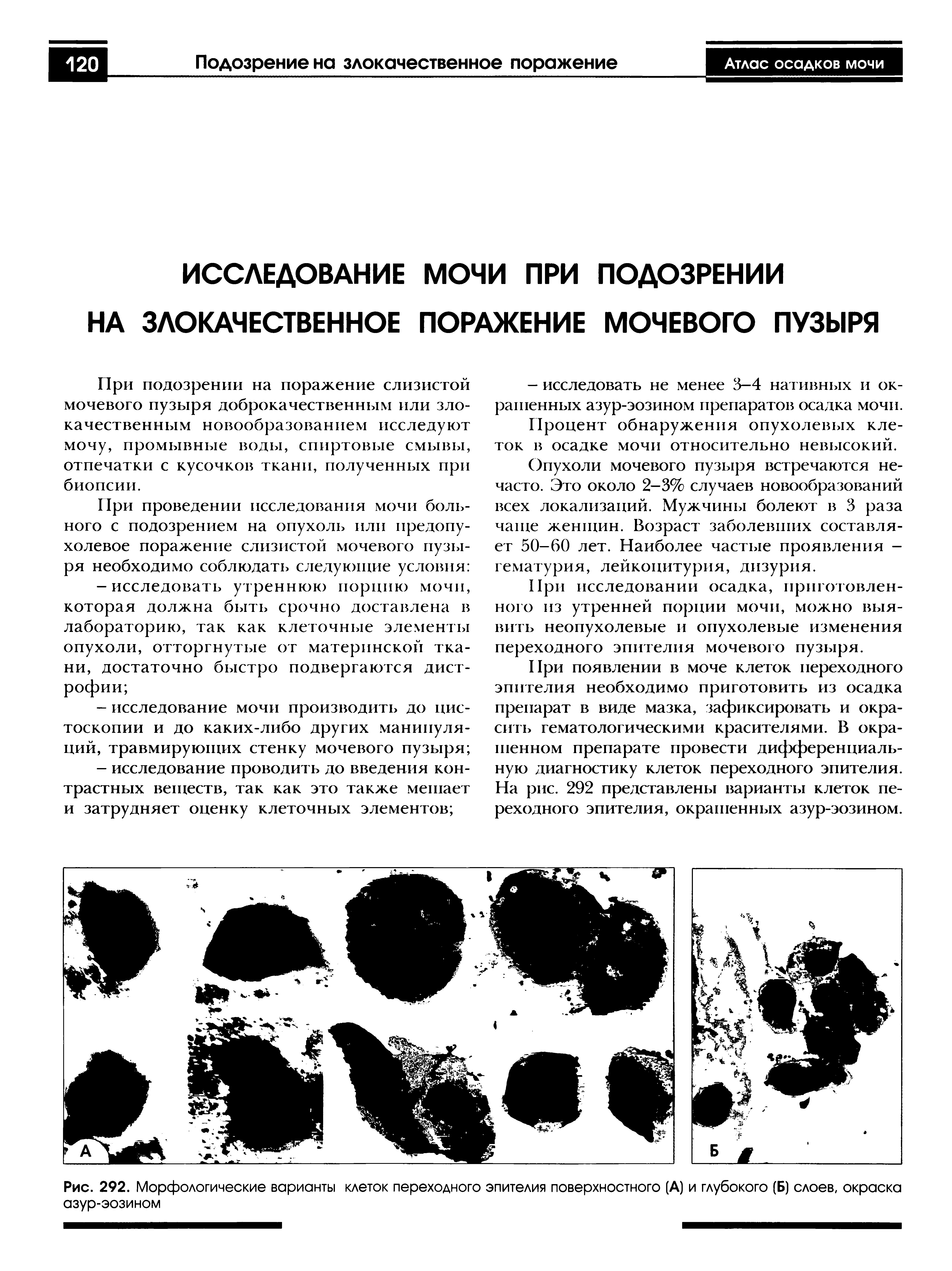 Рис. 292. Морфологические варианты клеток переходного эпителия поверхностного (А) и глубокого (Б) слоев, окраска азур-эозином...