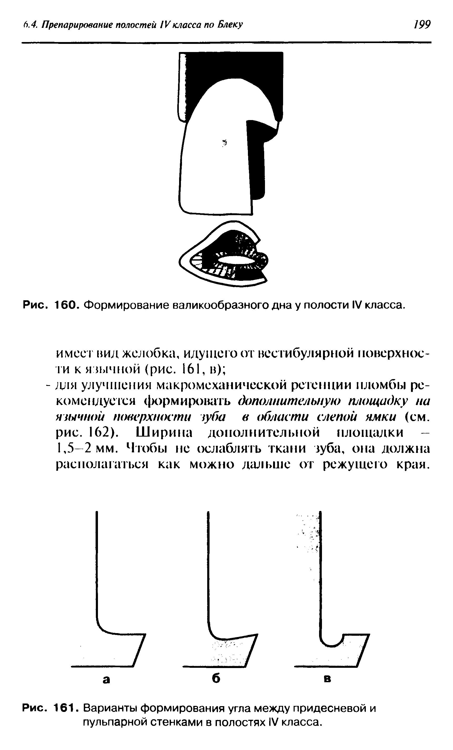 Рис. 161. Варианты формирования угла между придесневой и пульпарной стенками в полостях IV класса.