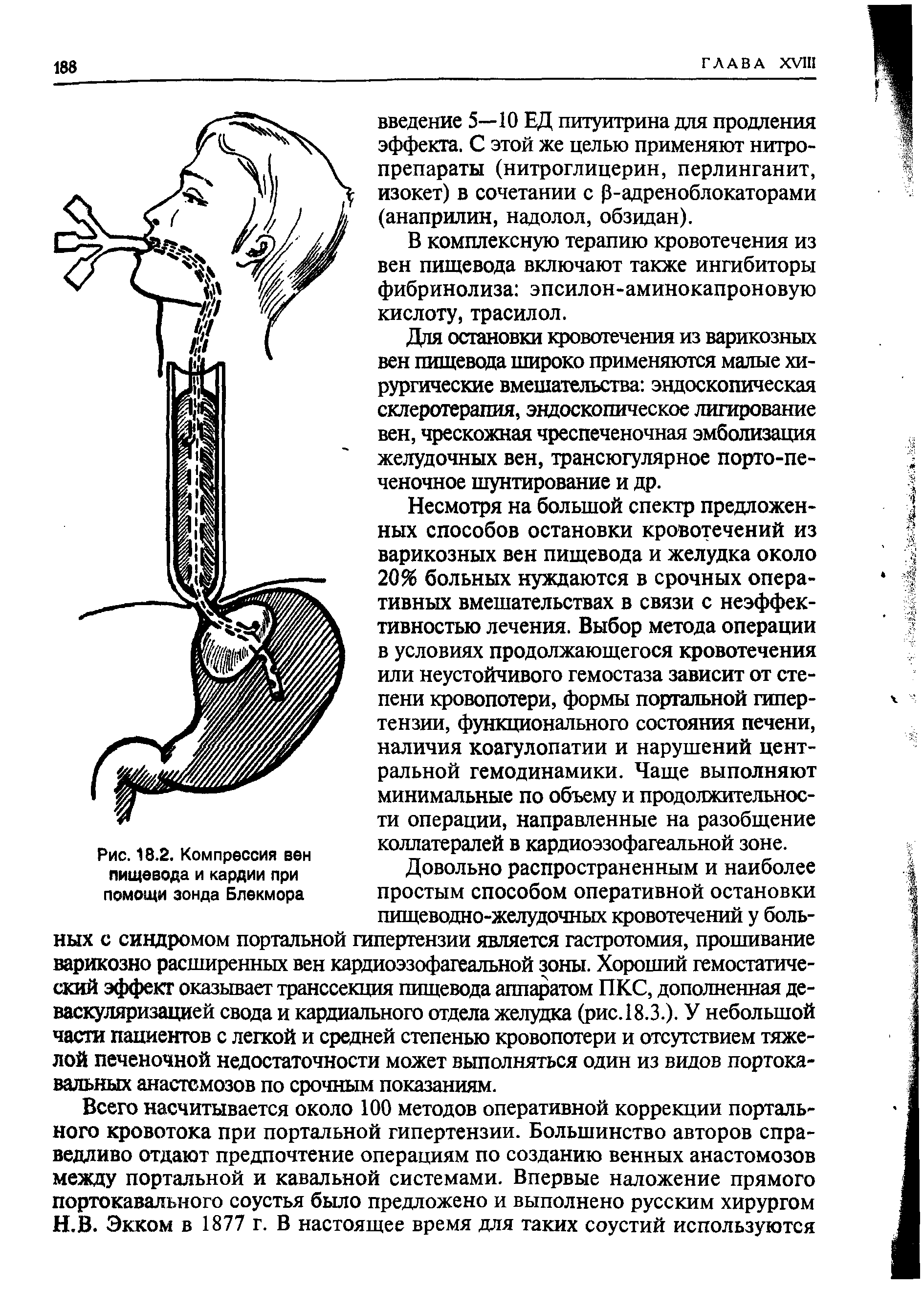 Рис. 18.2. Компрессия вен пищевода и кардии при помощи зонда Блекмора...