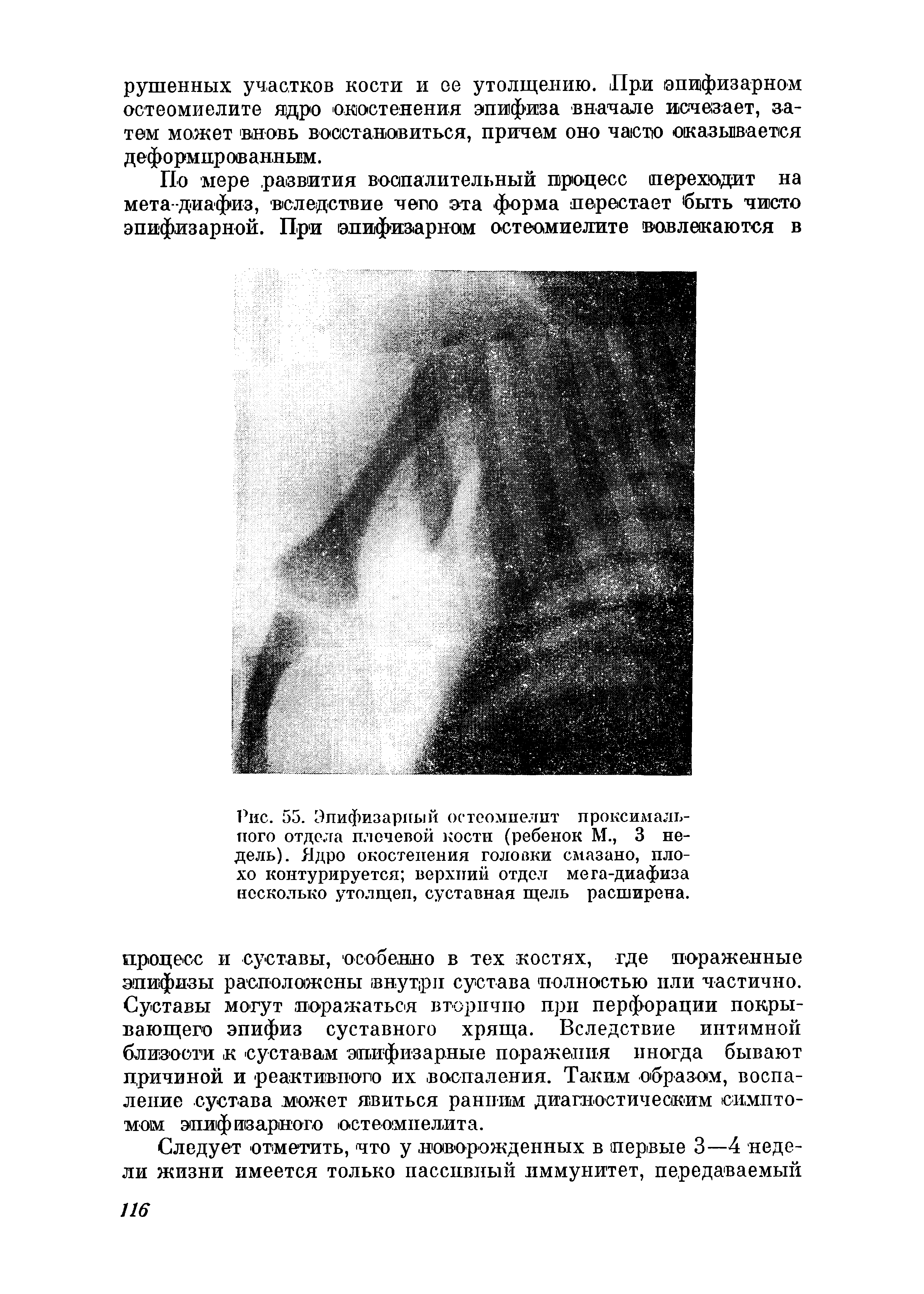 Рис. 55. Эпифизарный остеомиелит проксимального отдела плечевой кости (ребенок М., 3 недель). Ядро окостенения головки смазано, плохо контурируется верхний отдел мега-диафиза несколько утолщен, суставная щель расширена.