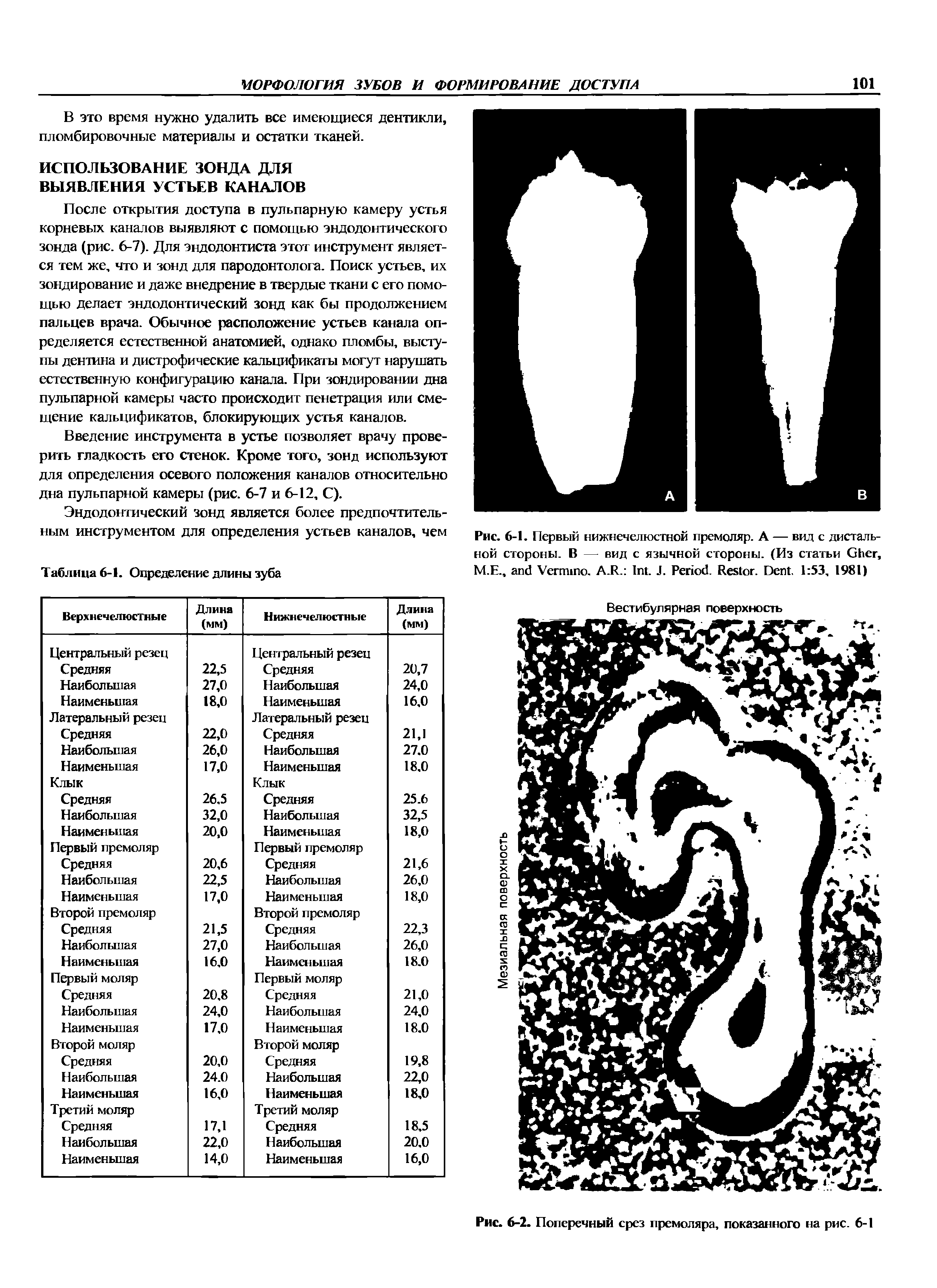 Рис. 6-1. Первый нижнечелюстной премоляр. А — вид с дистальной стороны. В — вид с язычной стороны. (Из статьи G , М.Е., V . A.R. I . J. P . R . D . 1 53, 1981)...