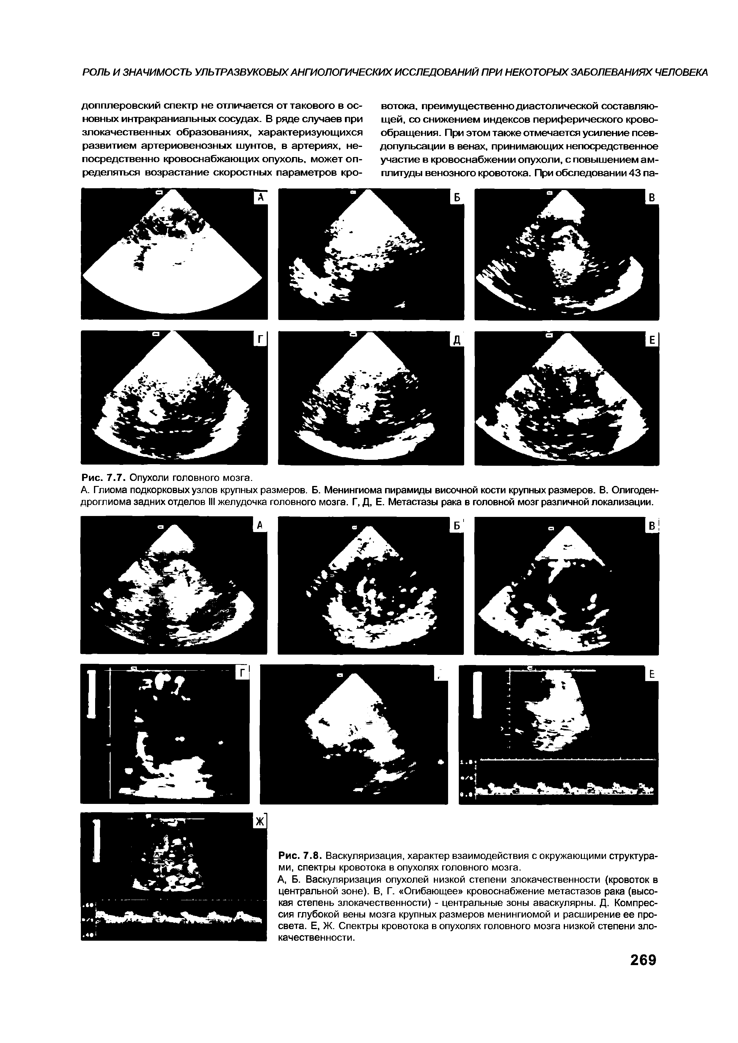 Рис. 7.8. Васкуляризация, характер взаимодействия с окружающими структурами, спектры кровотока в опухолях головного мозга.