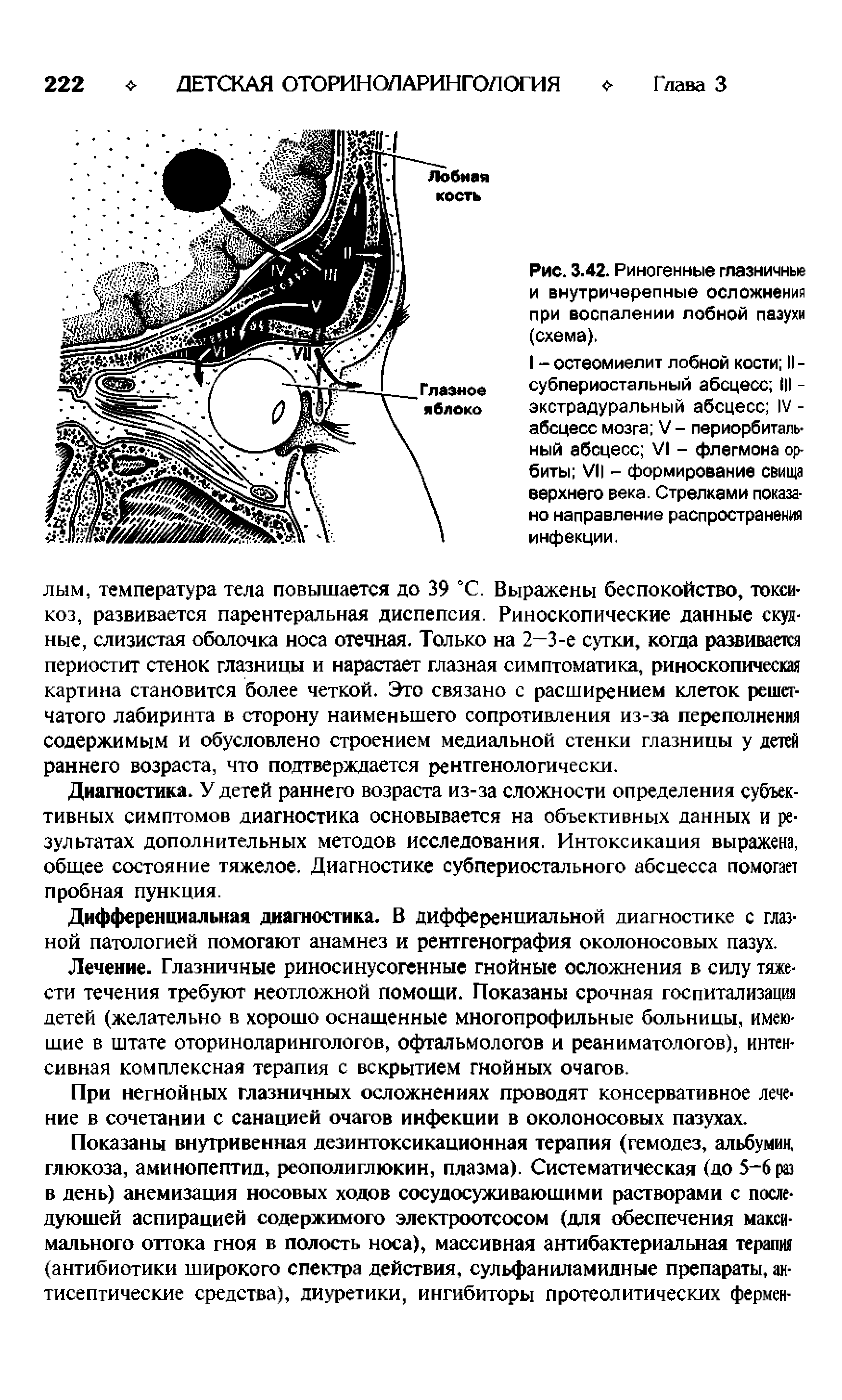 Рис. 3.42. Риногенные глазничнью и внутричерепные осложнения при воспалении лобной пазухи (схема).