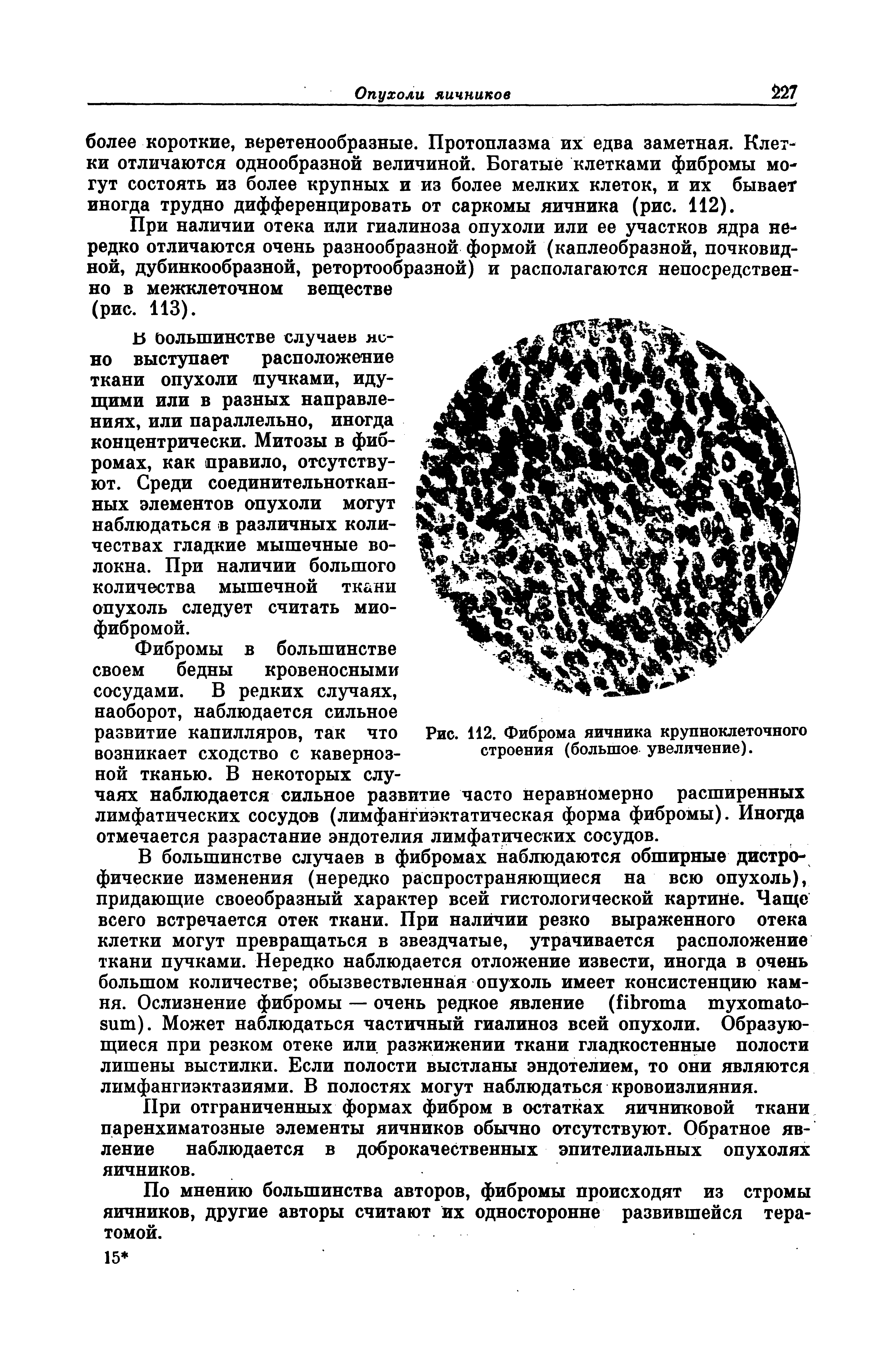 Рис. 112. Фиброма яичника крупноклеточного строения (большое увеличение).