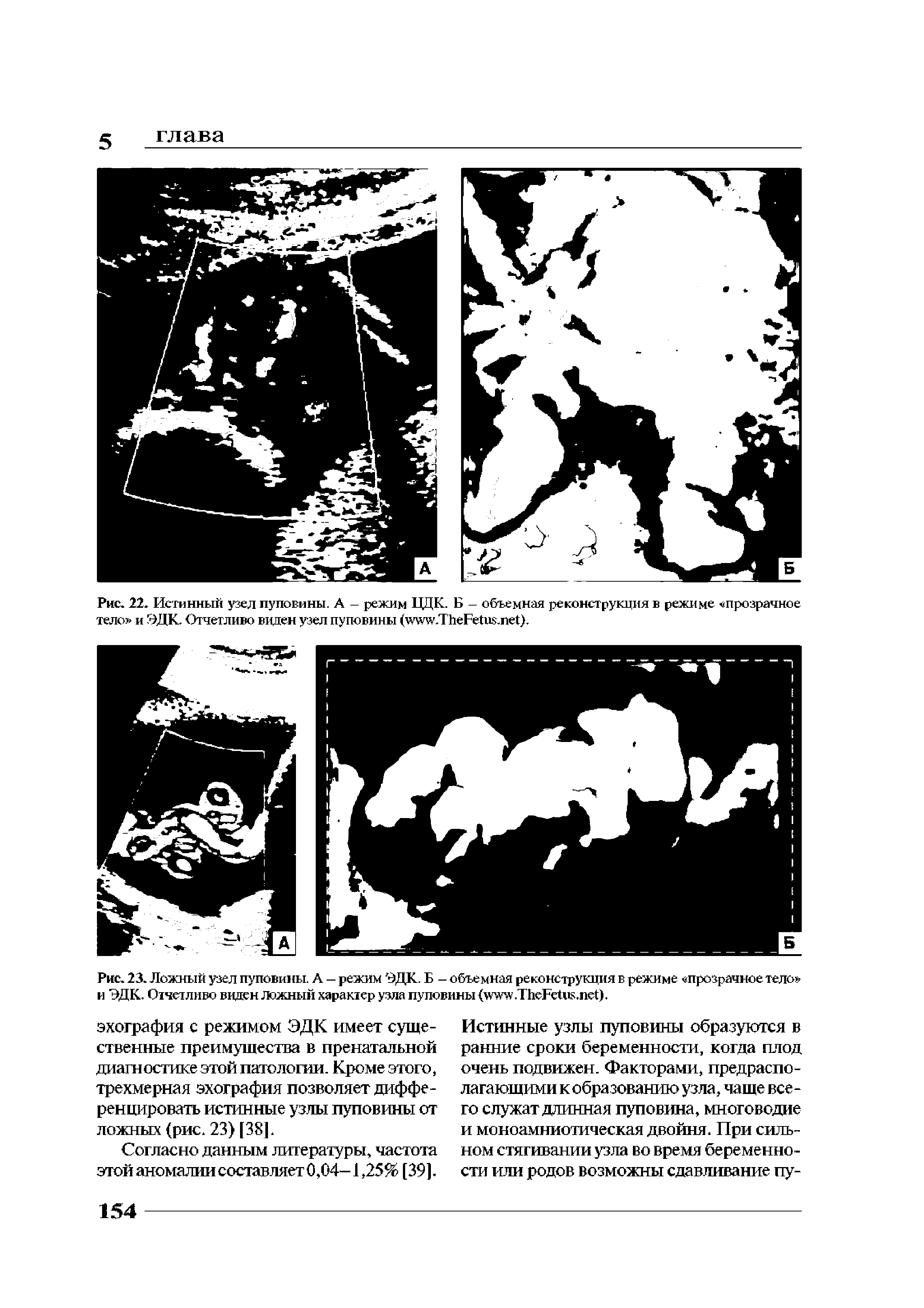 Рис. 23. Ложный узел пуповины. А — режим ЭДК. Б - объемная реконструкция в режиме прозрачное тело и ЭДК. Отчетливо виден ложный характер узла пуповины ( .T F . ).