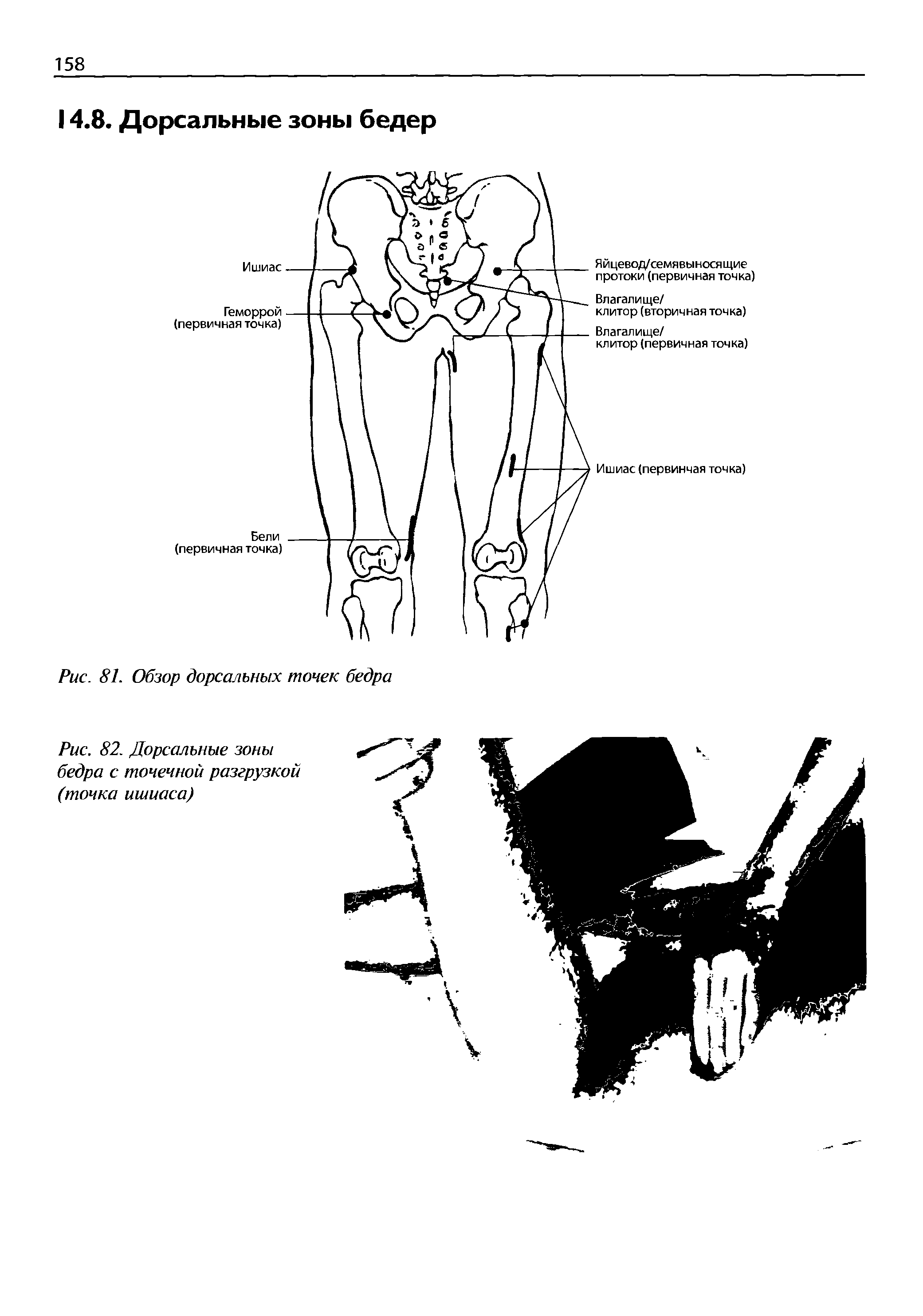 Рис. 82. Дорсальные зоны бедра с точечной разгрузкой (точка ишиаса)...