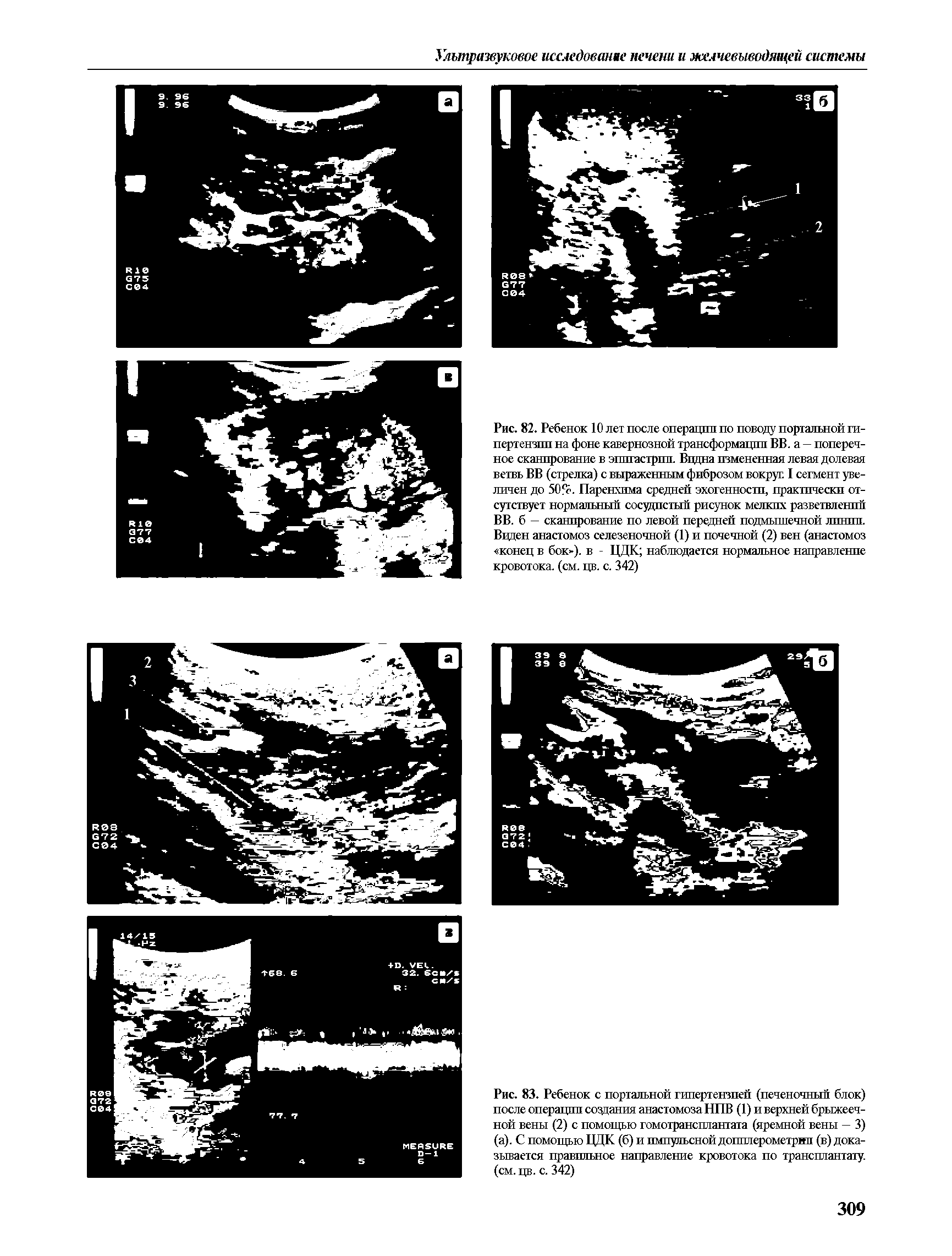 Рис. 83. Ребенок с портальной гипертензией (печеночный блок) после операции создания анастомоза НПВ (1) и верхней брыжеечной вены (2) с помощью гомотрансплантата (яремной вены — 3) (а). С помощью ЦДК (б) и импульсной допплерометрии (в) доказывается правильное направление кровотока по трансплантату, (см. цв. с. 342)...