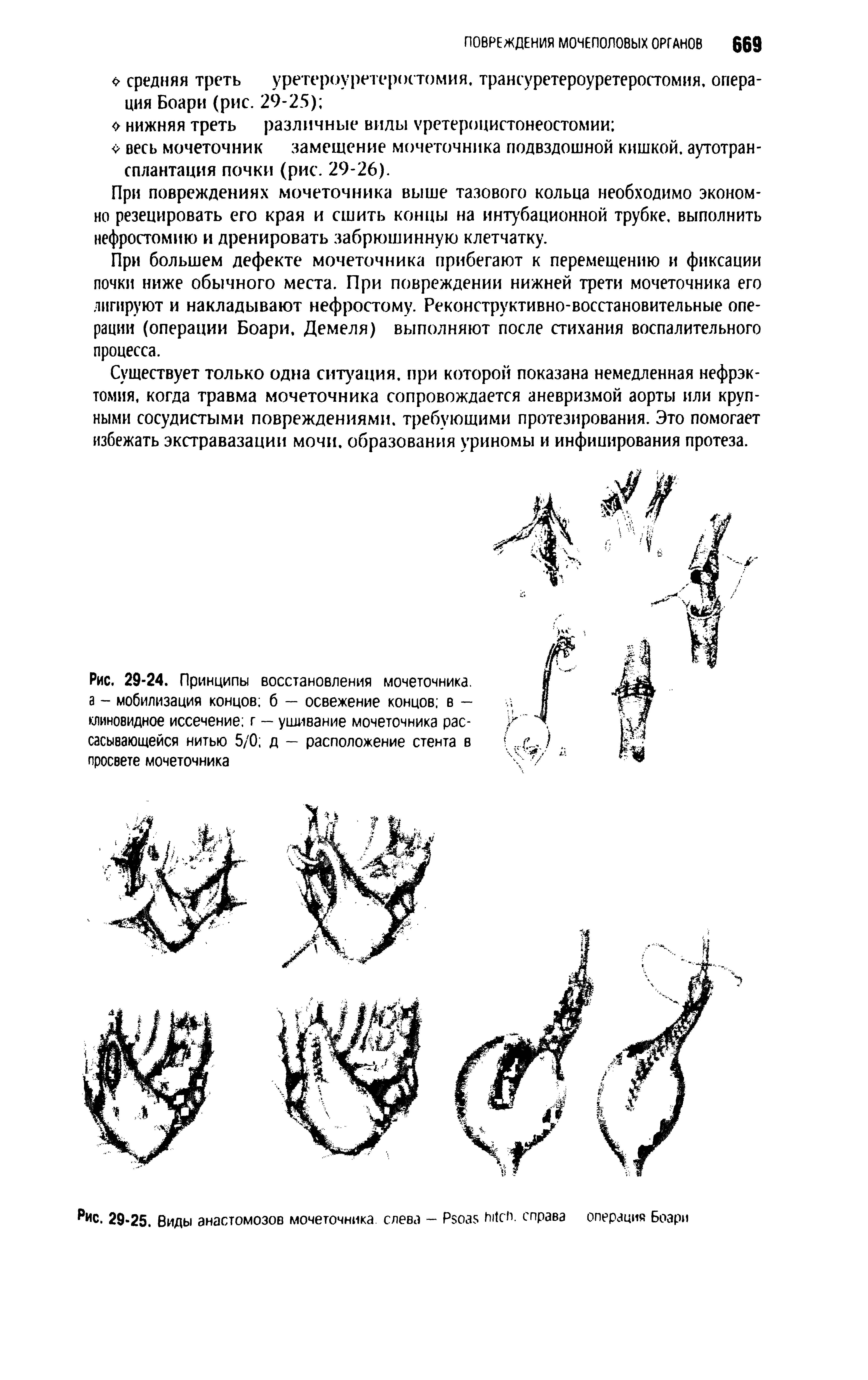 Рис. 29-24. Принципы восстановления мочеточника, а - мобилизация концов б — освежение концов, в — клиновидное иссечение г — ушивание мочеточника рассасывающейся нитью 5/0 д — расположение стента в просвете мочеточника...