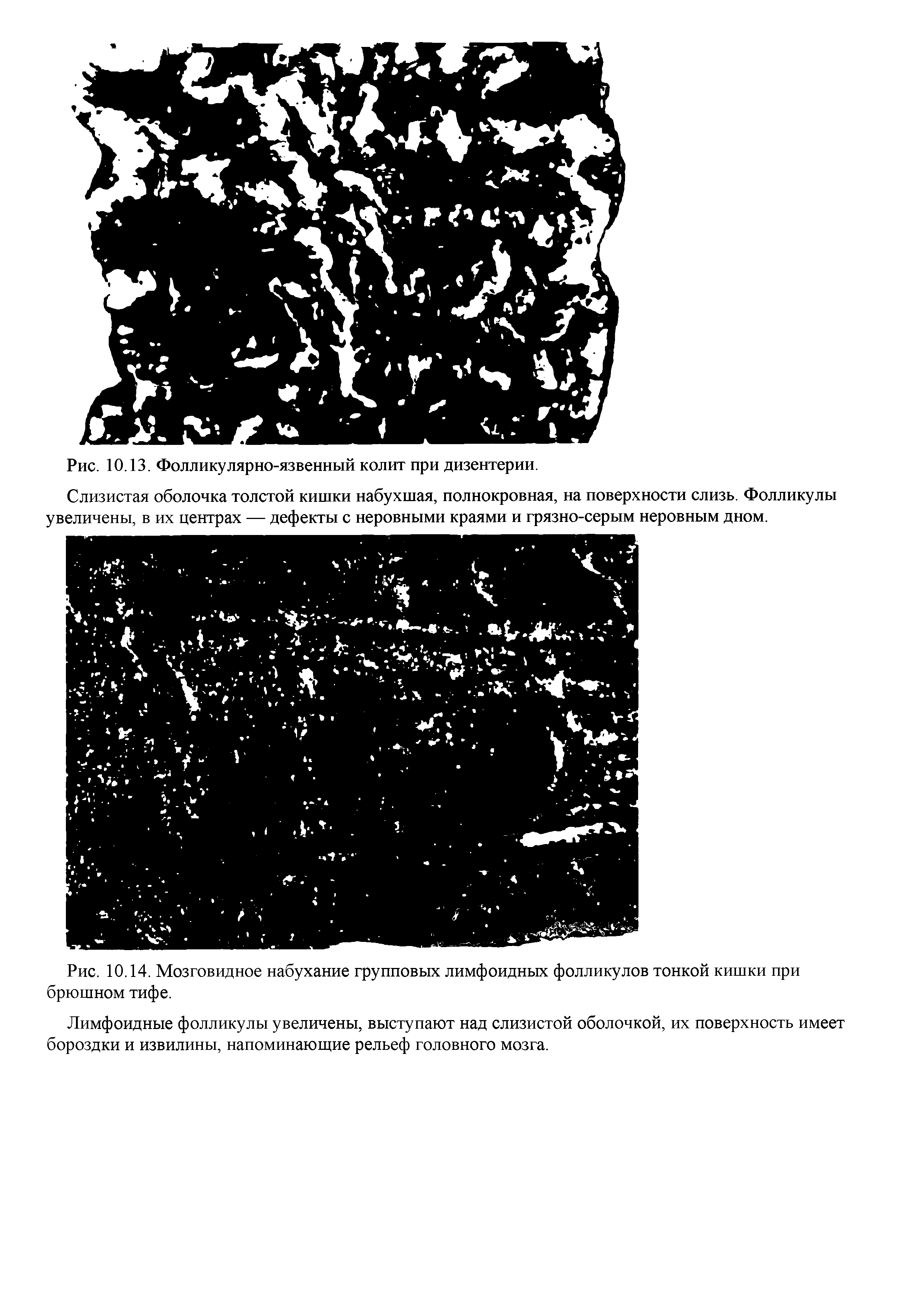 Рис. 10.14. Мозговидное набухание групповых лимфоидных фолликулов тонкой кишки при брюшном тифе.