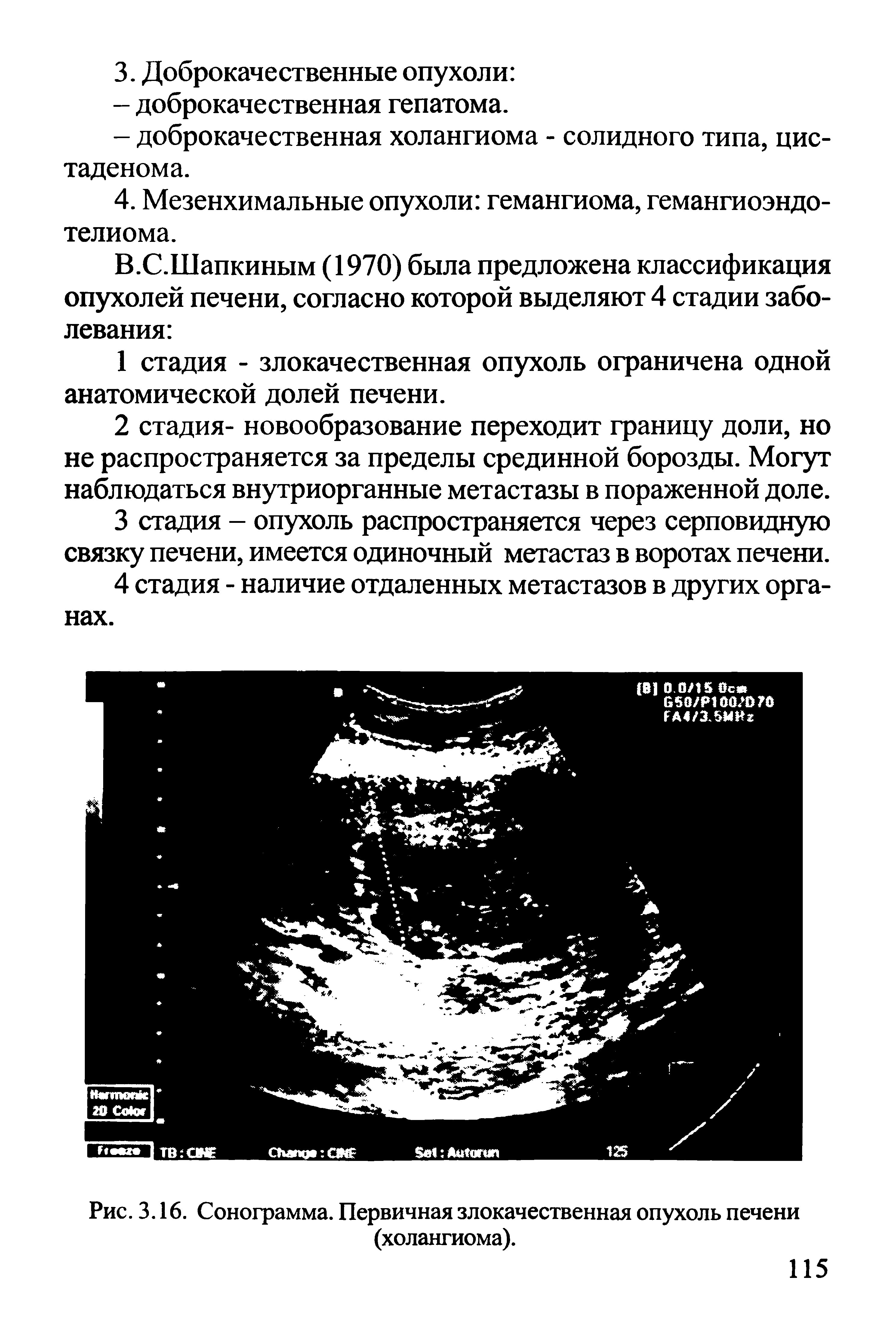 Рис. 3.16. Сонограмма. Первичная злокачественная опухоль печени (холангиома).