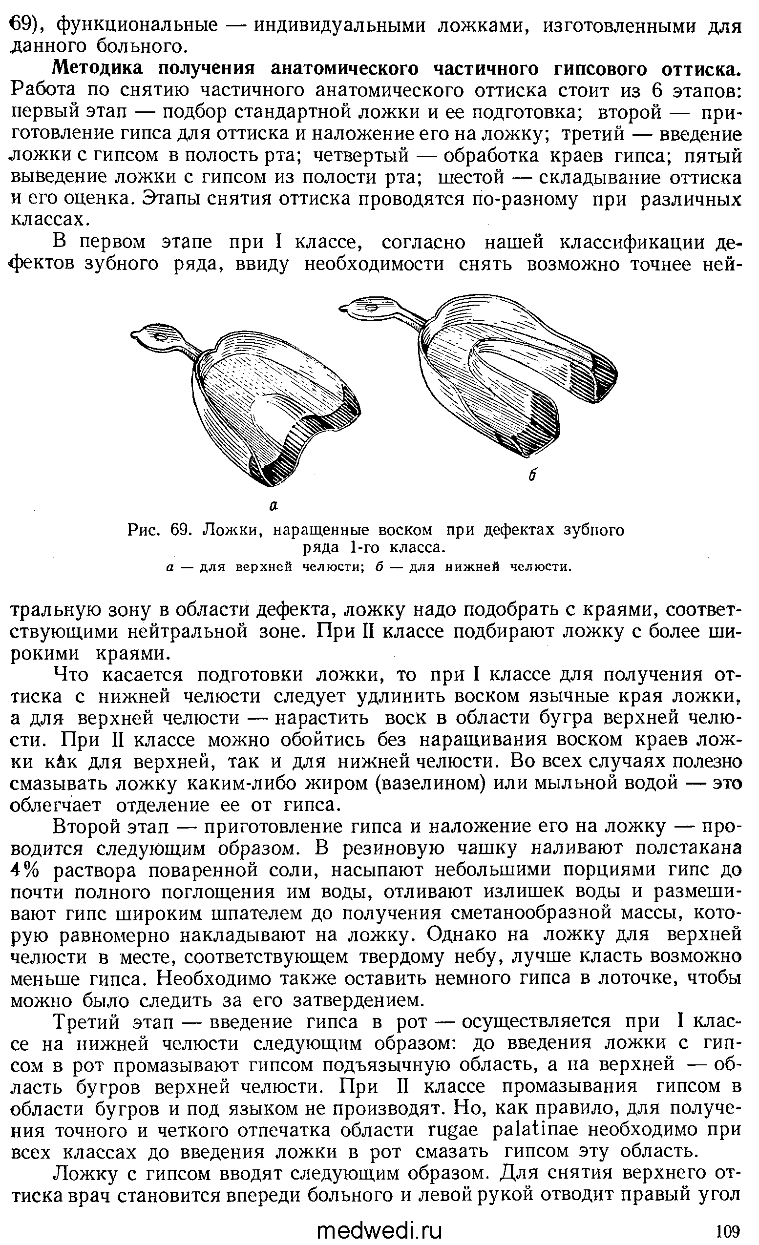 Рис. 69. Ложки, наращенные воском при дефектах зубного ряда 1-го класса.