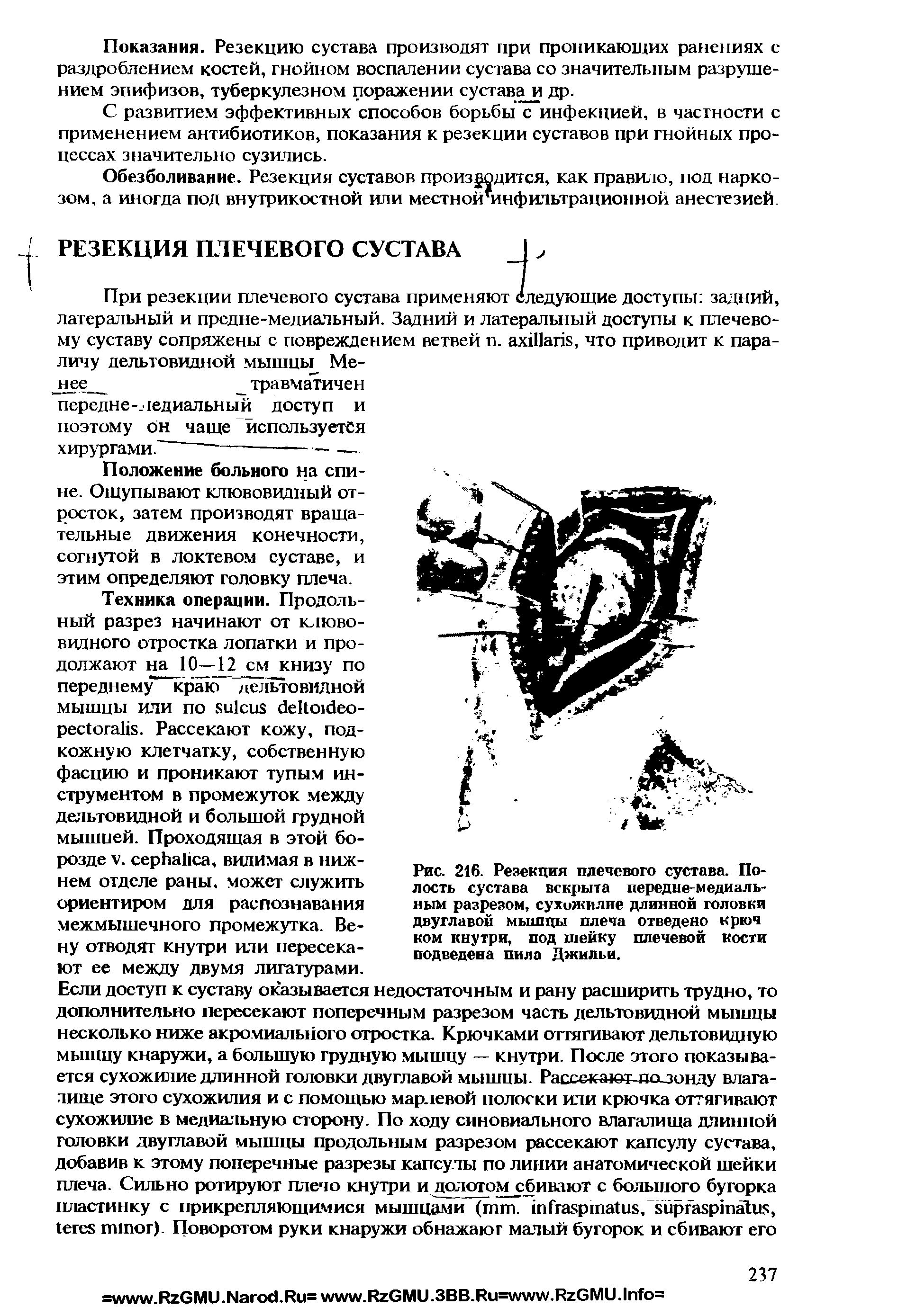 Рис. 216. Резекция плечевого сустава. Полость сустава вскрыта передне-медиальным разрезом, сухожилие длинной головки двуглавой мышцы плеча отведено крюч ком кнутри, под шейку плечевой кости подведена пила Джильи.