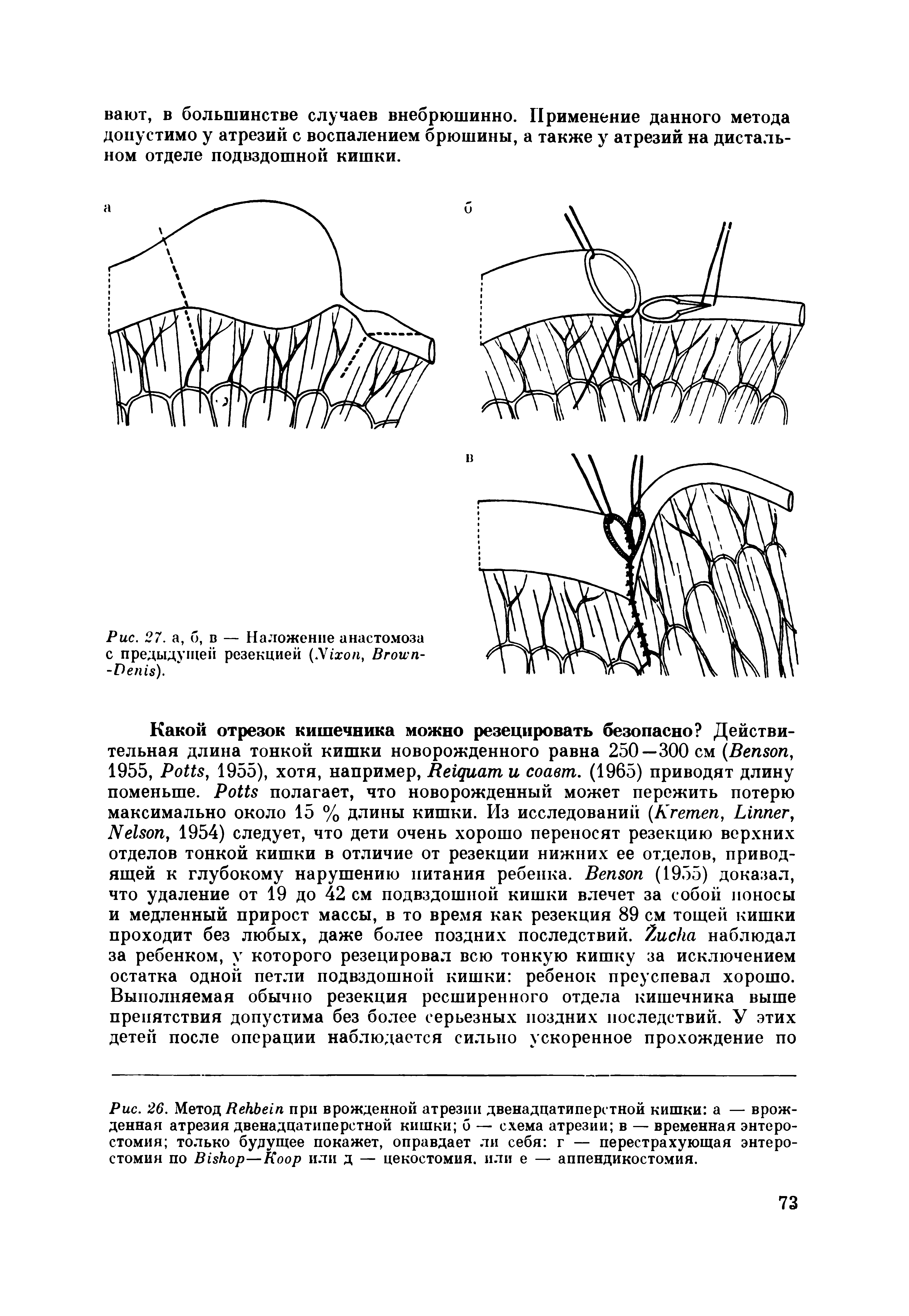 Рис. 26. Метол B при врожденной атрезии двенадцатиперстной кишки а — врожденная атрезия двенадцатиперстной кишки б — схема атрезии в — временная энтеро-стомия только будущее покажет, оправдает ли себя г — перестрахующая энтеро-стомия по B —K или д — цекостомия. или е — аппендикостомия.