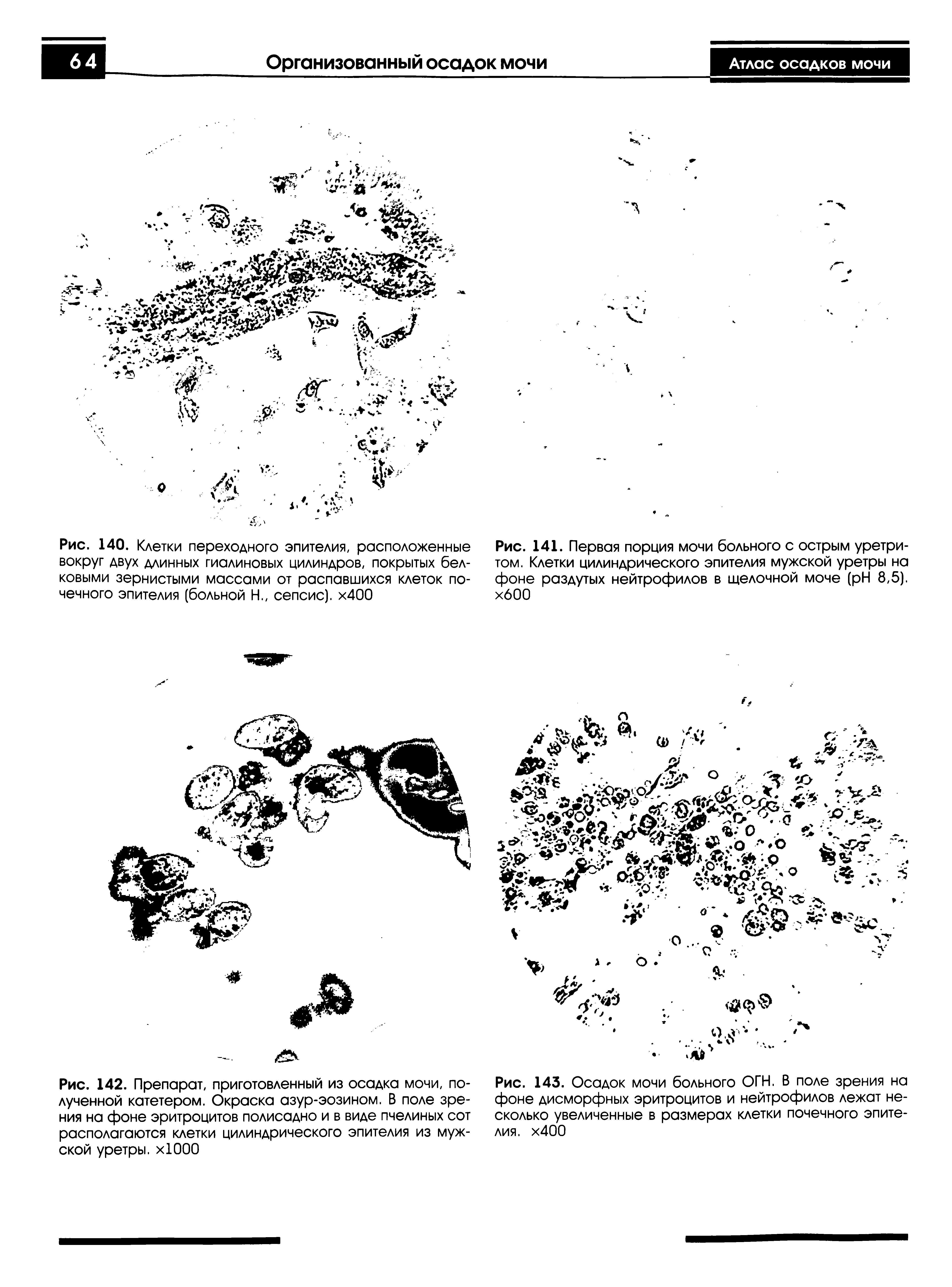 Рис. 142. Препарат, приготовленный из осадка мочи, полученной катетером. Окраска азур-эозином. В поле зрения на фоне эритроцитов полисадно и в виде пчелиных сот располагаются клетки цилиндрического эпителия из мужской уретры. хЮОО...